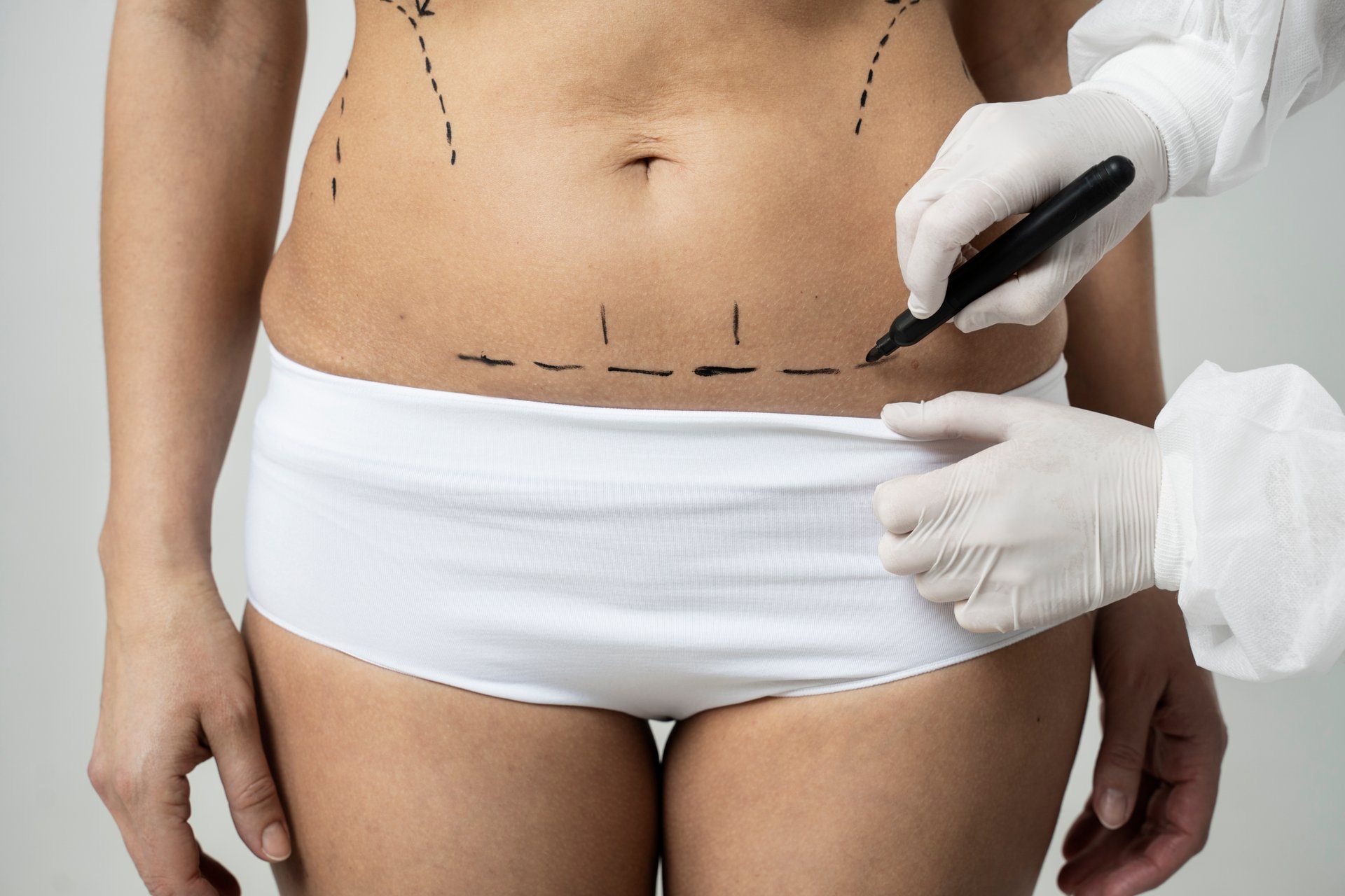 Abdominoplastika: ko je kandidat i šta očekivati?