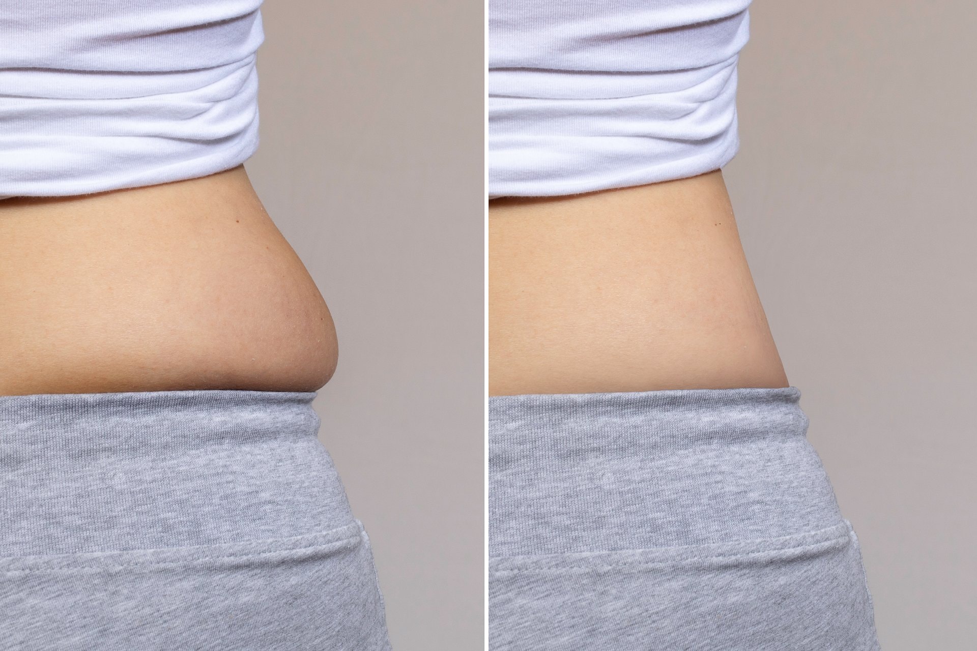Abdominoplastika: ko je kandidat i šta očekivati?