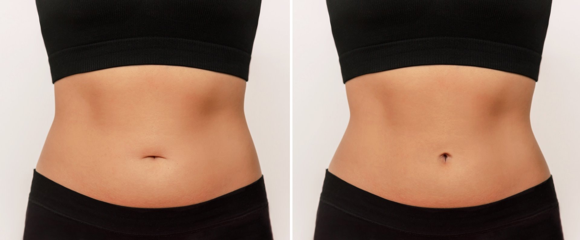 Abdominoplastika vs. liposukcija: koja procedura je za vas?