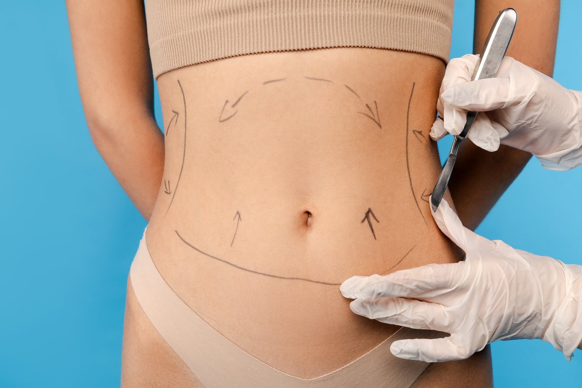 Abdominoplastika vs. liposukcija: koja procedura je za vas?