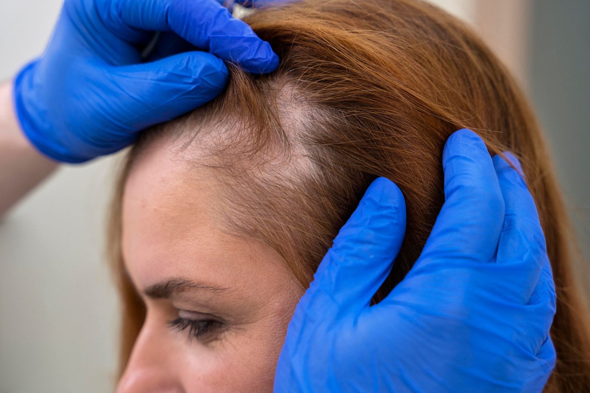 Alopecija: Sve o uzrocima i kliničkim rješenjima u regiji