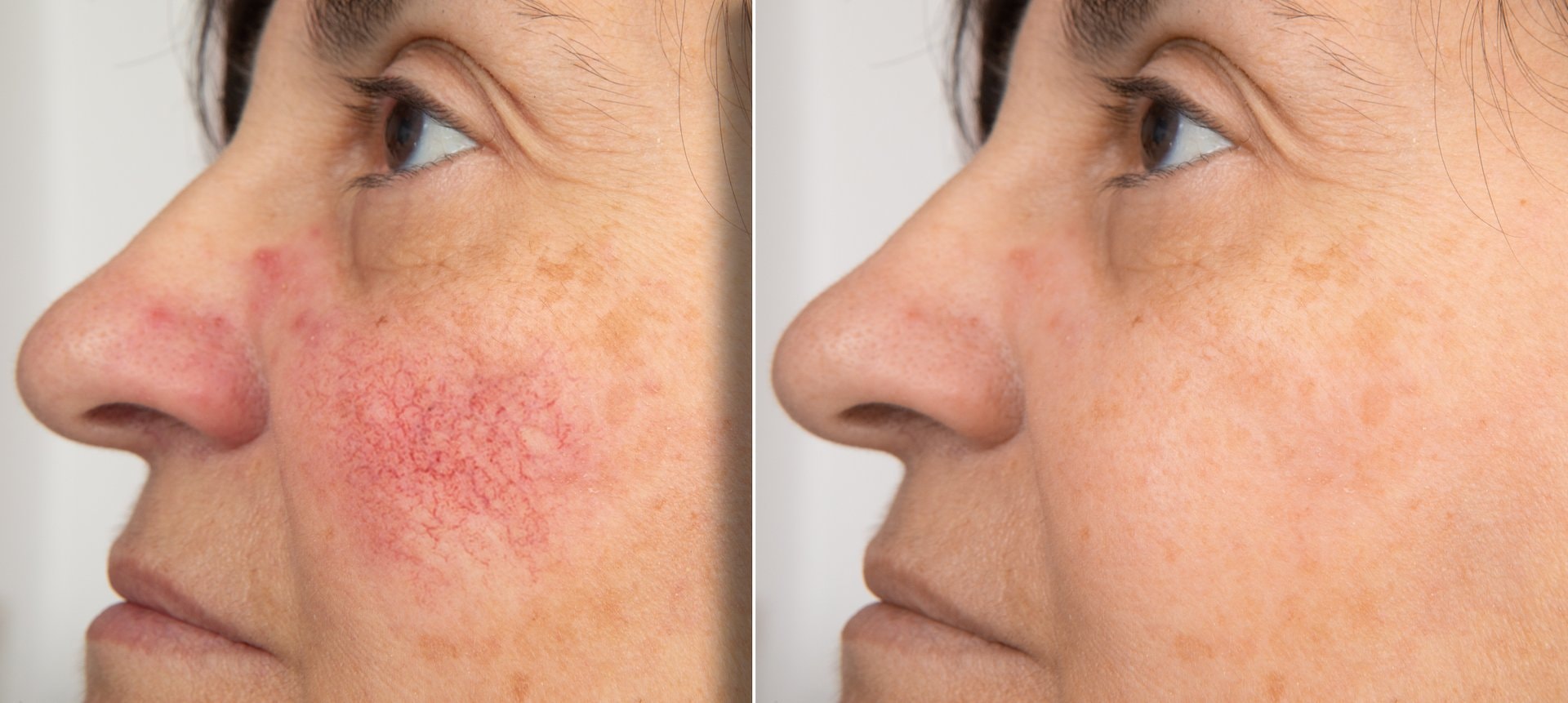 Antiinflamatorna ishrana za rozaceu: sedmični jelovnik