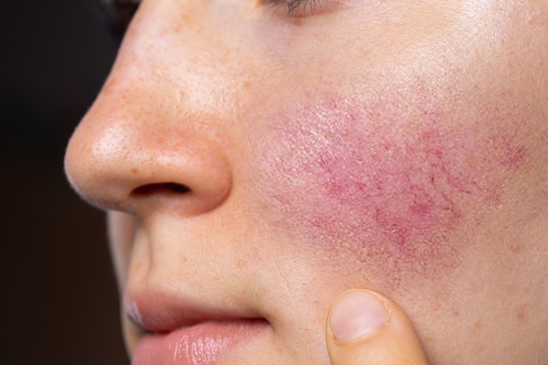 Antiinflamatorna ishrana za rozaceu: sedmični jelovnik