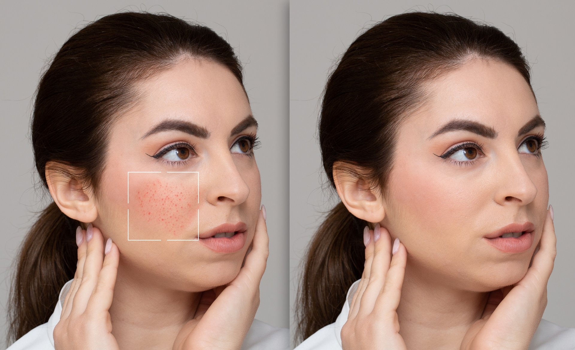 Barrier repair: obnova kožne barijere kao beauty filozofija