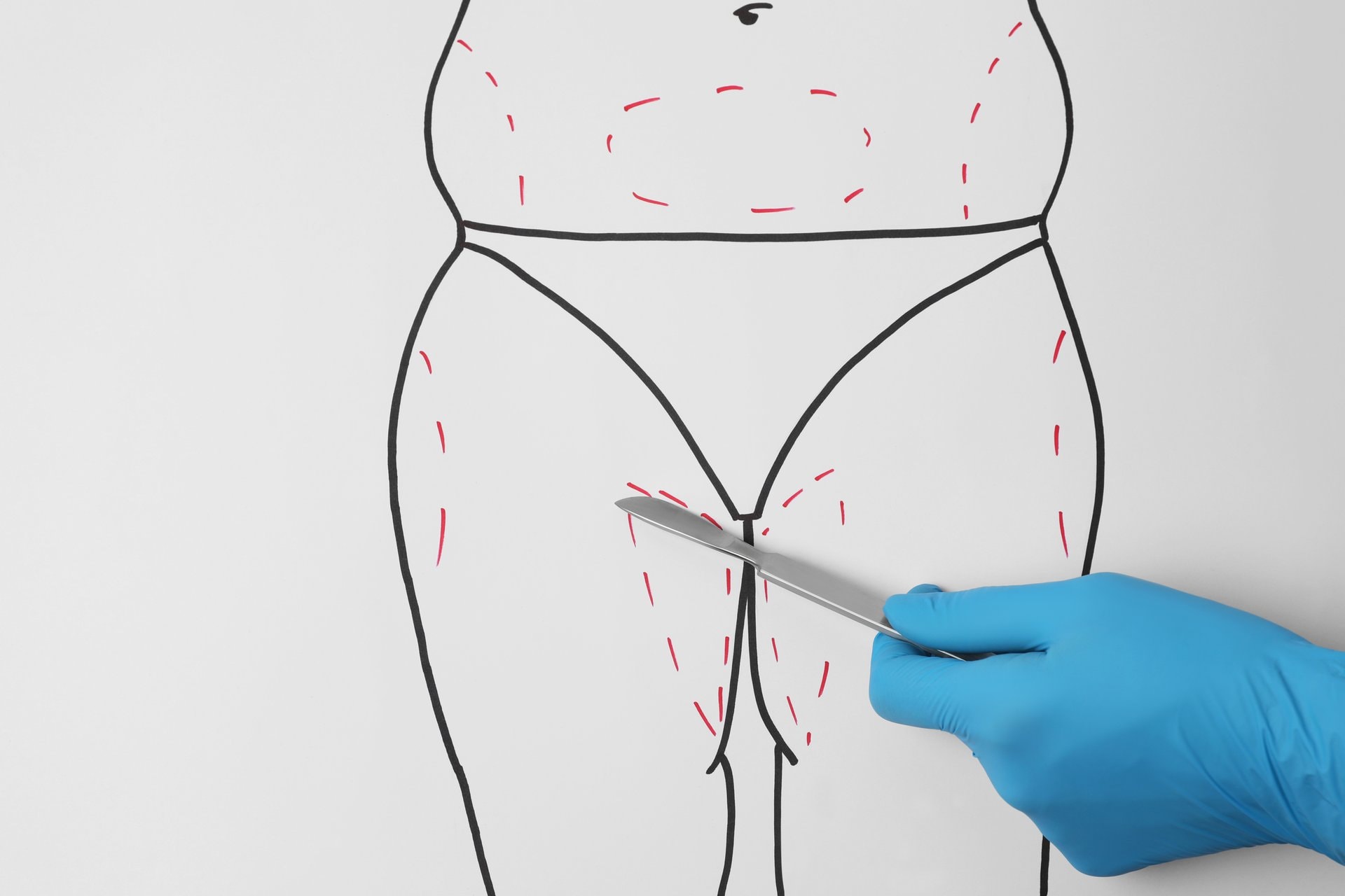 BBL (Brazilian Butt Lift): šta trebate znati prije odluke