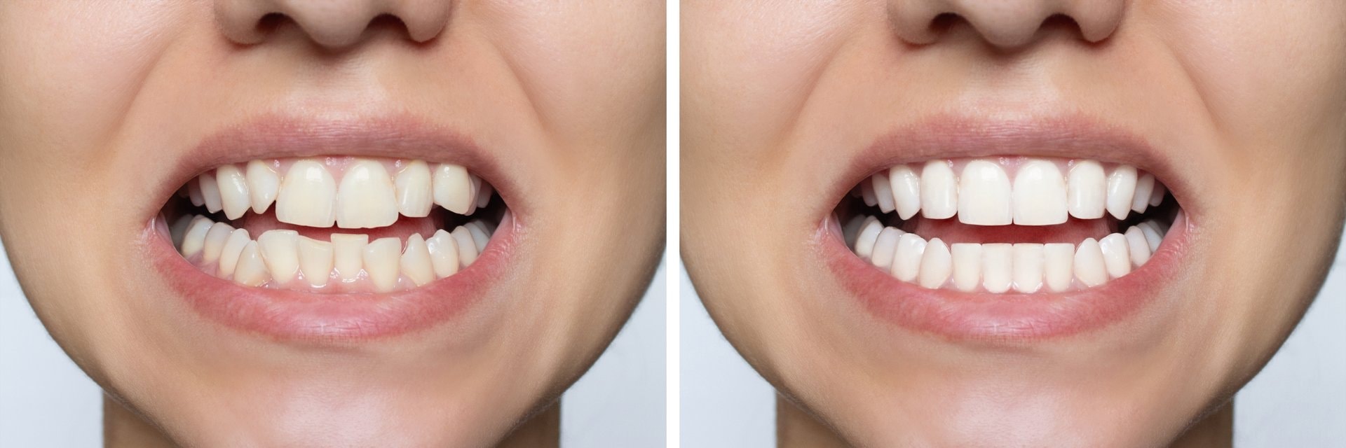 Bleaching zuba kod kuće vs. kod stomatologa