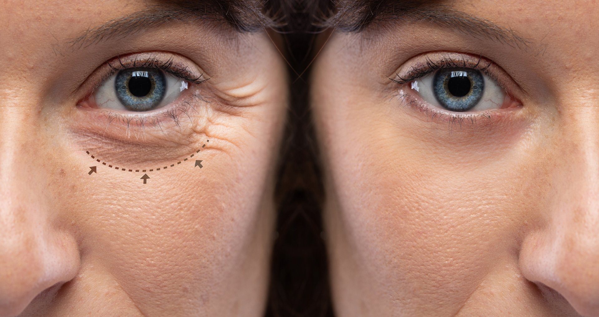 Blepharoplastika: operacija kapaka koja osvježava pogled