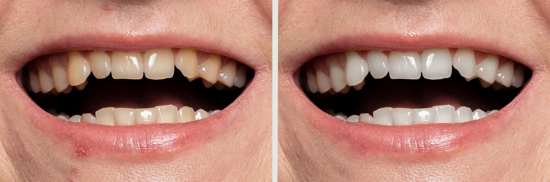 Dental bonding: brza korekcija zuba bez brusenja