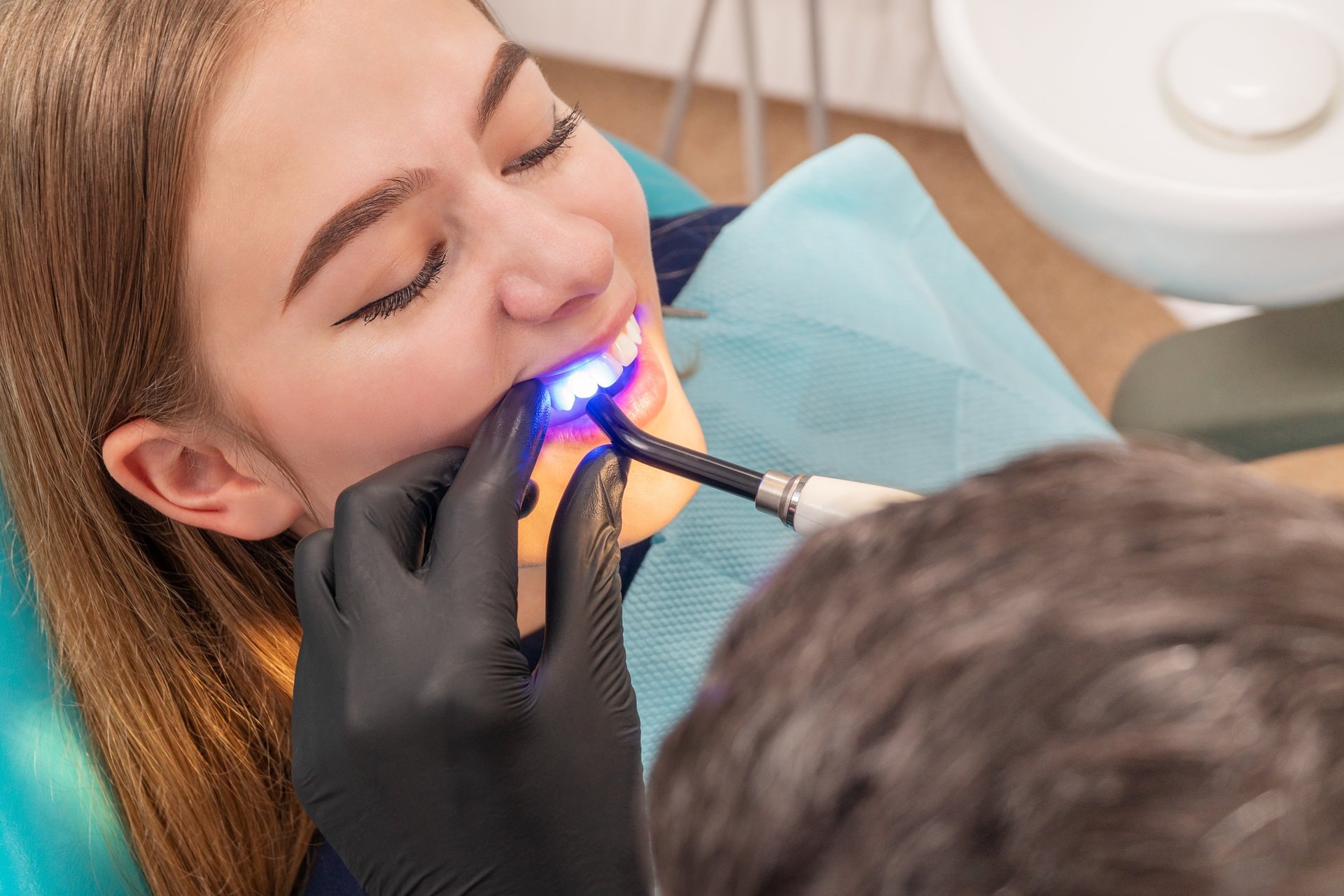 Dental bonding: brza korekcija zuba bez brusenja