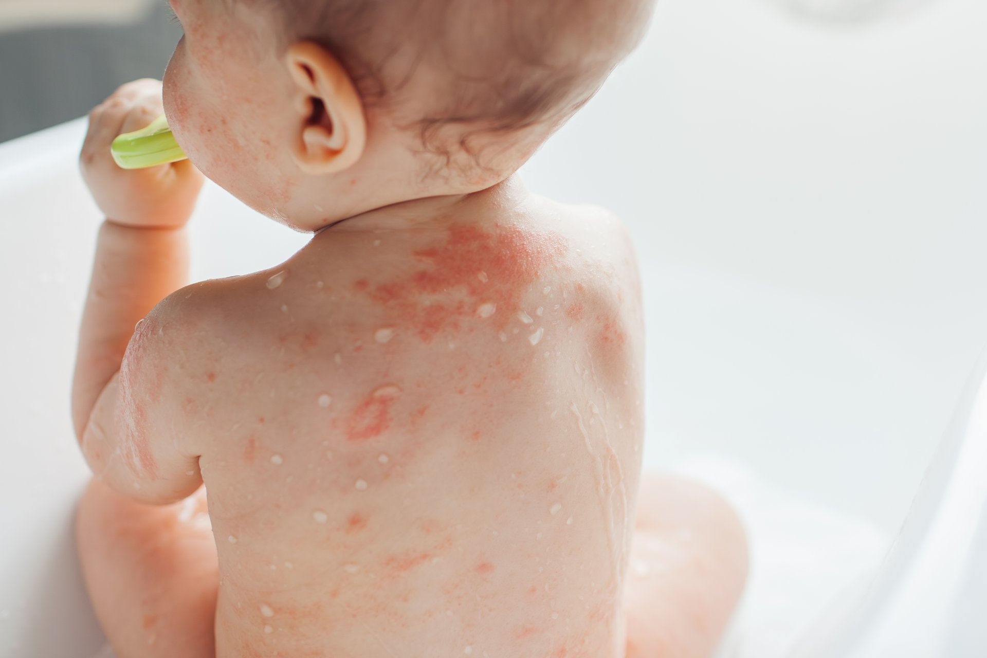 Dermatitis kod beba: znakovi i šta koristiti za njegu