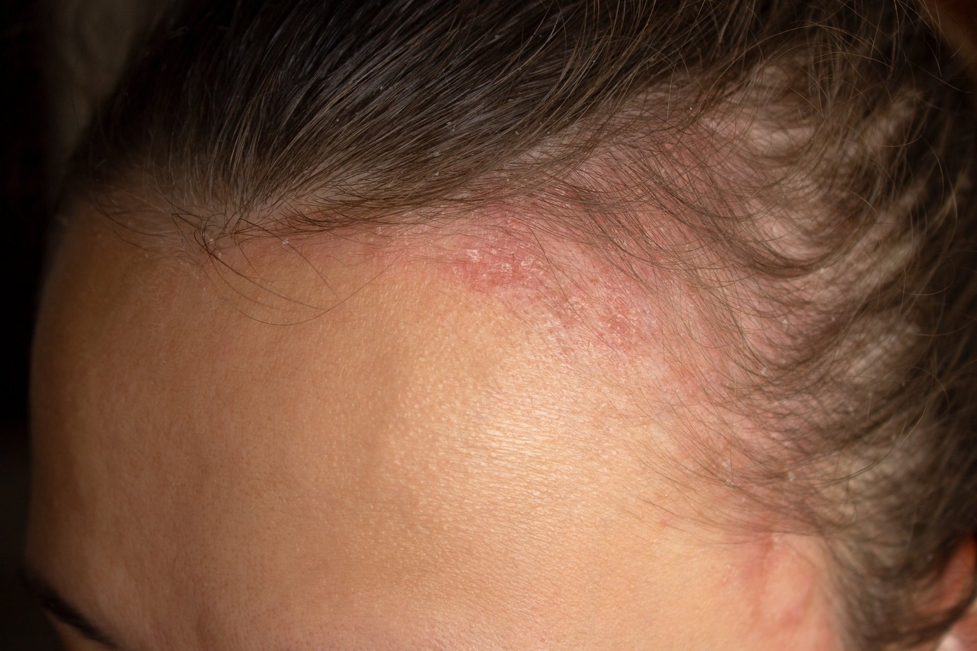 Dermatitis na vlasištu: uzroci, simptomi i pravilna njega