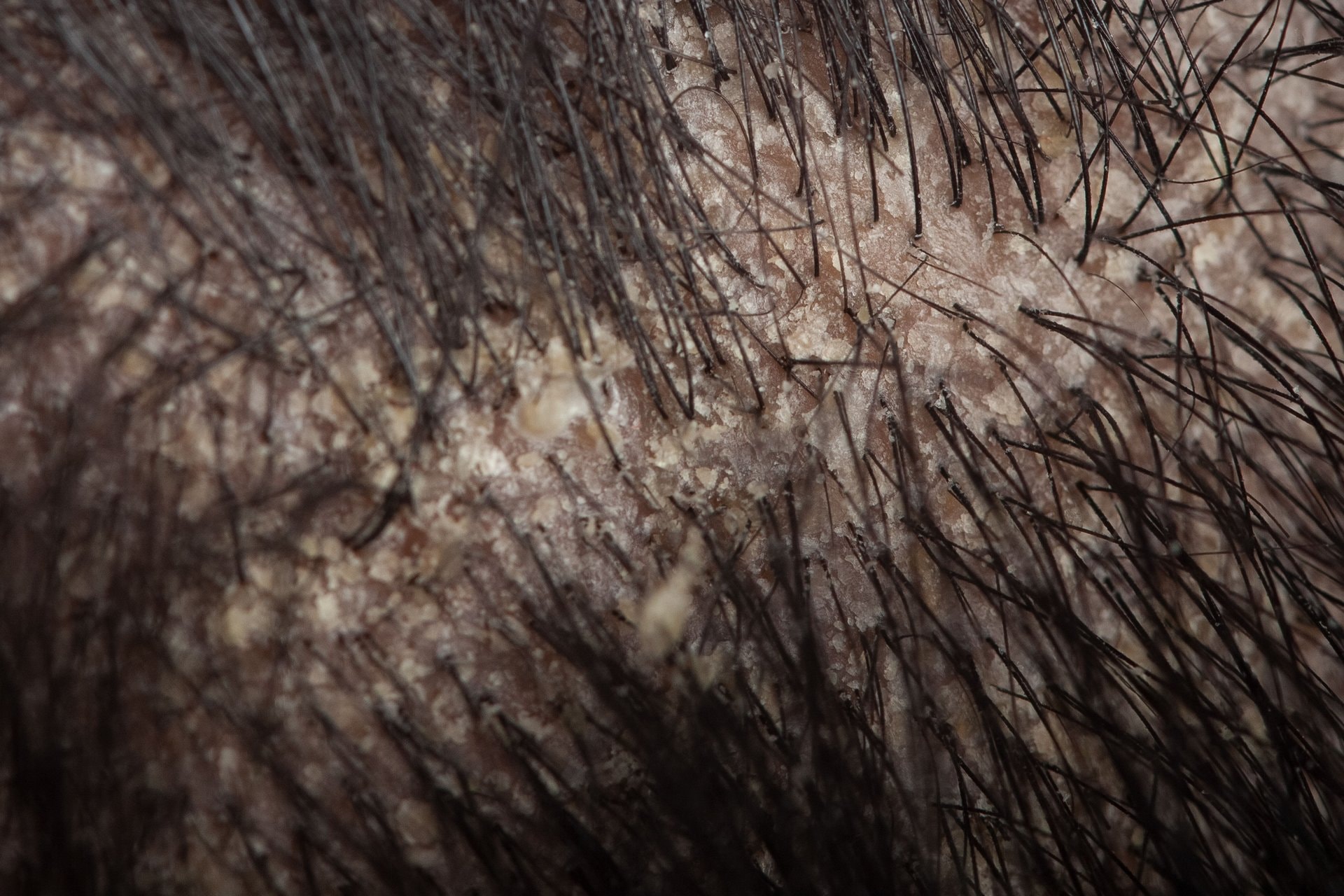 Dermatitis na vlasištu: uzroci, simptomi i pravilna njega