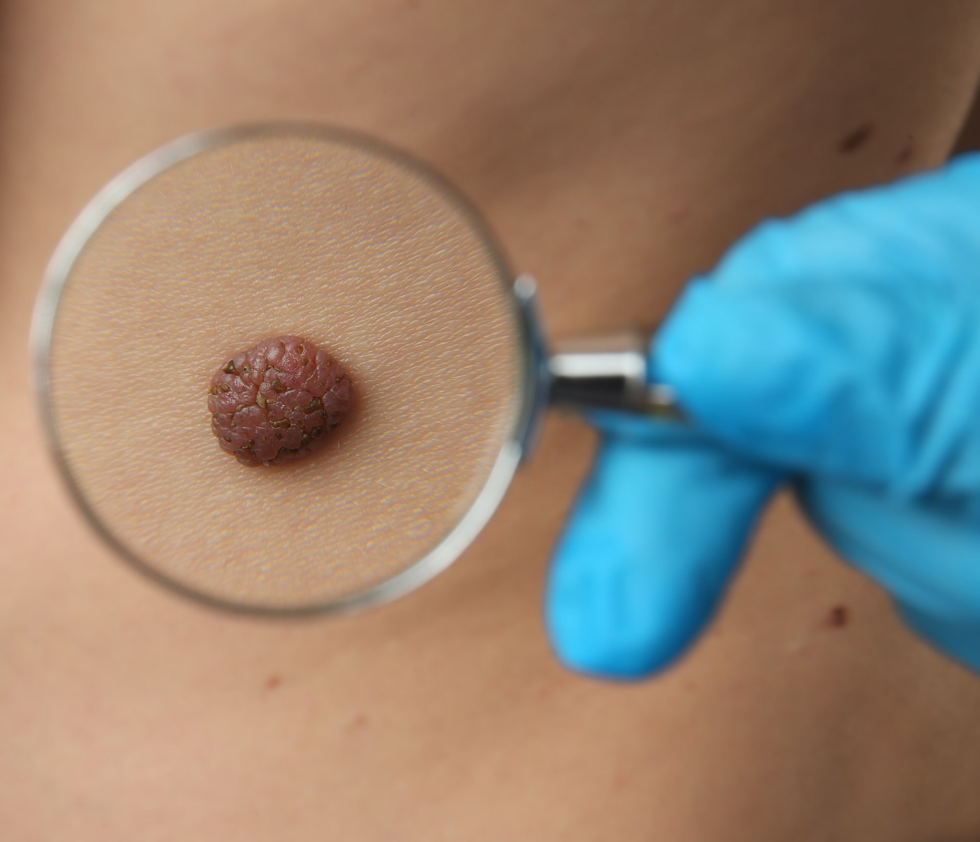 Dermatoskopija u BiH: pregled madeža koji može spasiti život