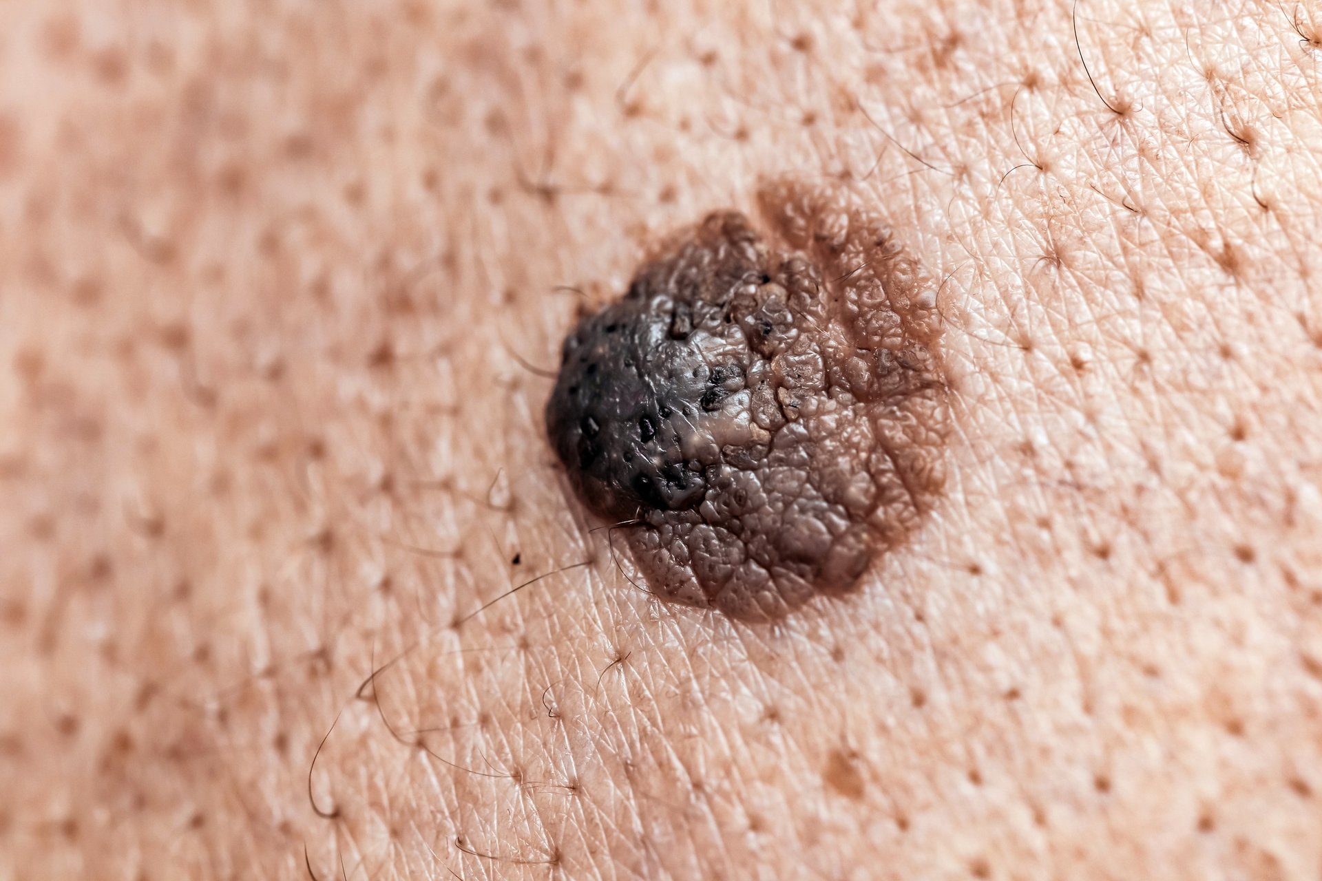 Dermatoskopija u BiH: pregled madeža koji može spasiti život