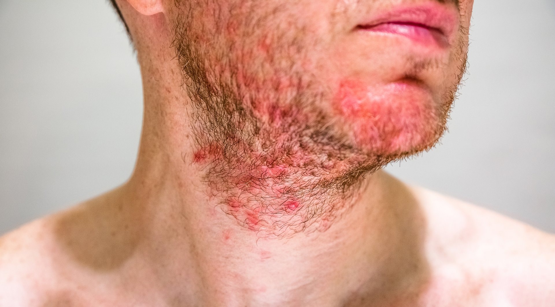 Ekcem kod odraslih: kako živjeti s atopijskim dermatitisom