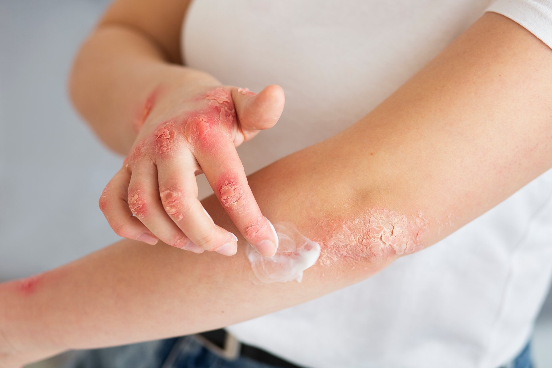 Ekcem kod odraslih: kako živjeti s atopijskim dermatitisom