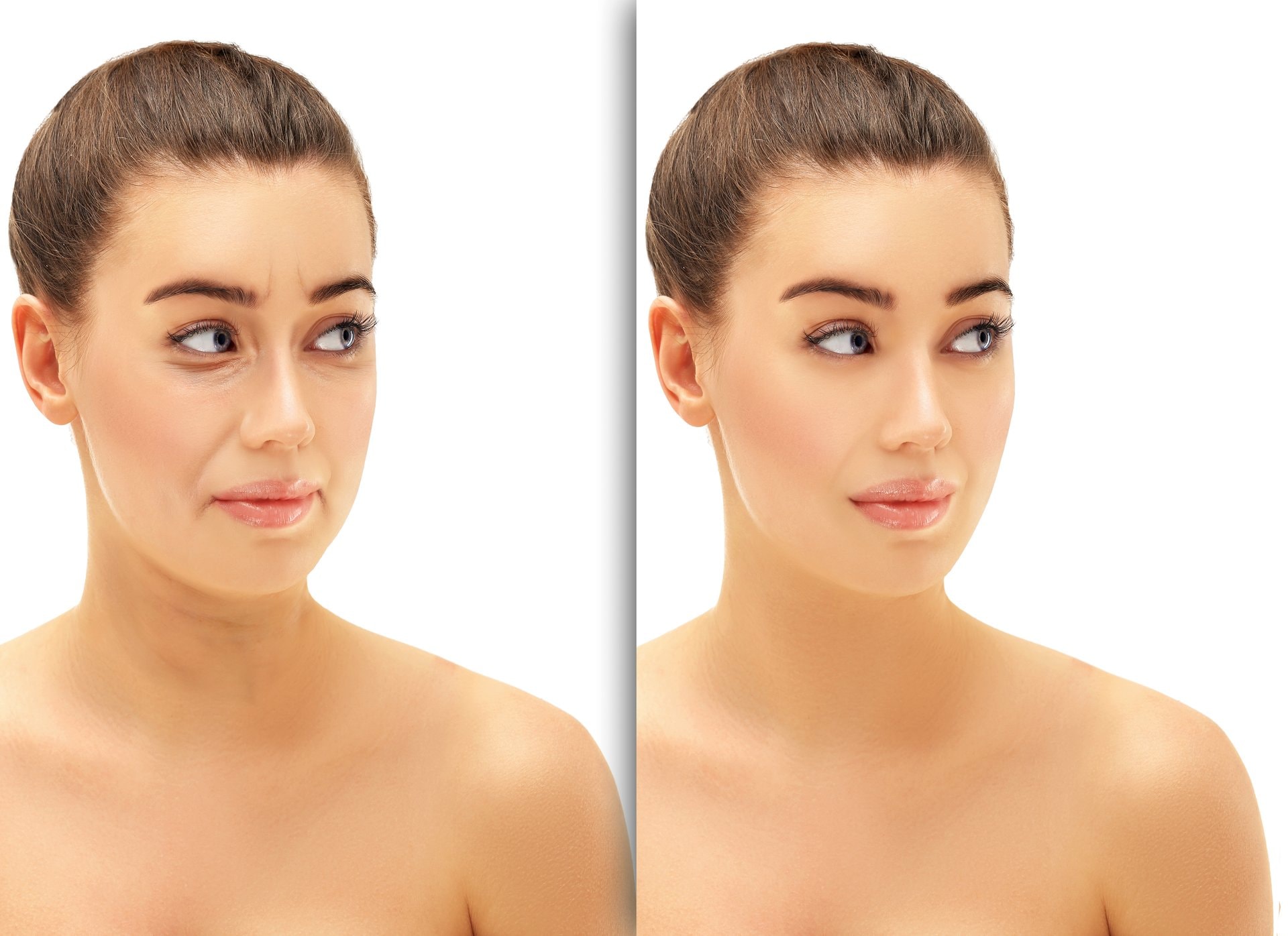 Endolift laser: nova generacija face liftinga