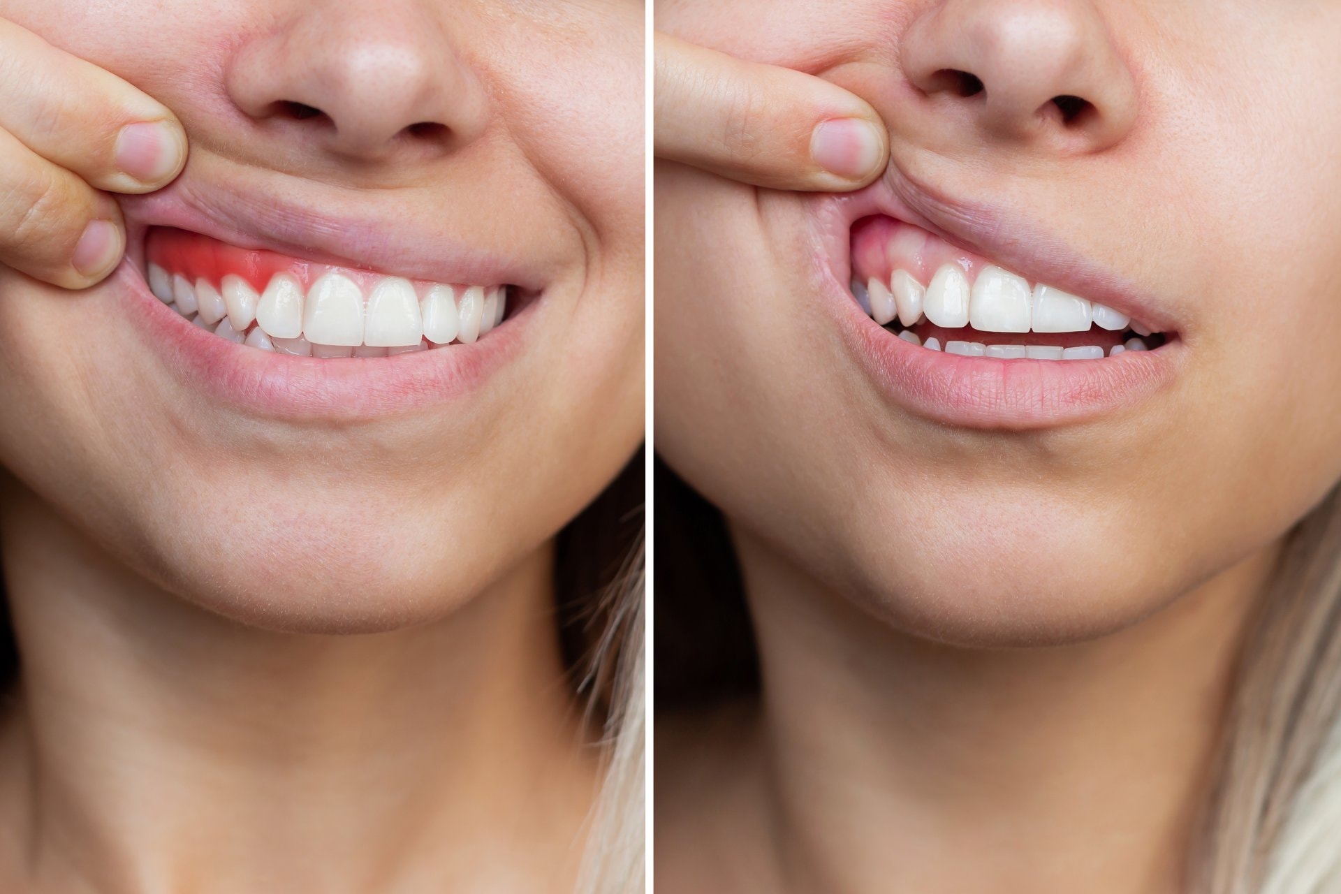 Gingivalni osmijeh: korekcija gummy smile-a u BiH