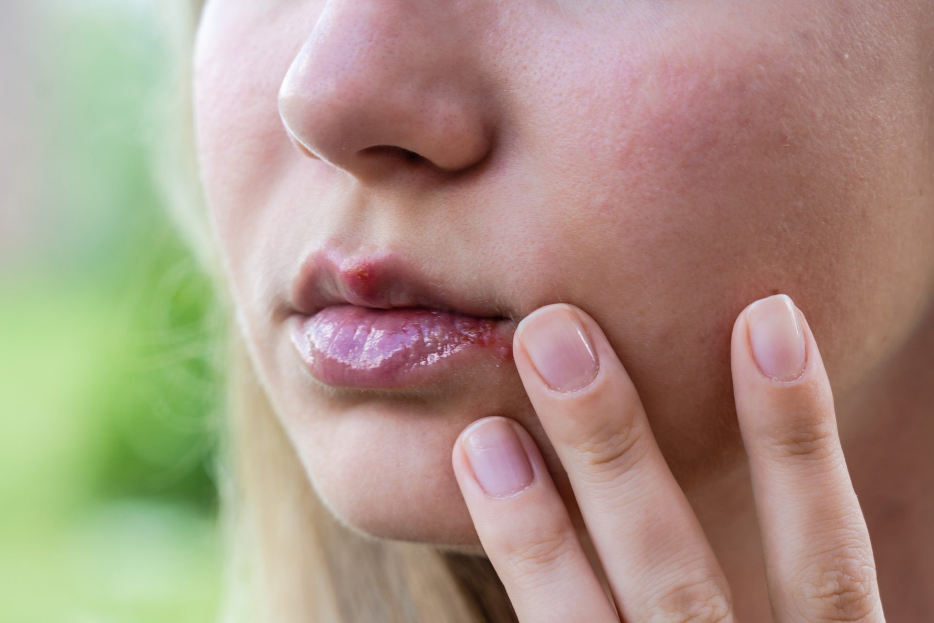 Herpes i njega usana: kako skratiti epizode i zaštititi kožu