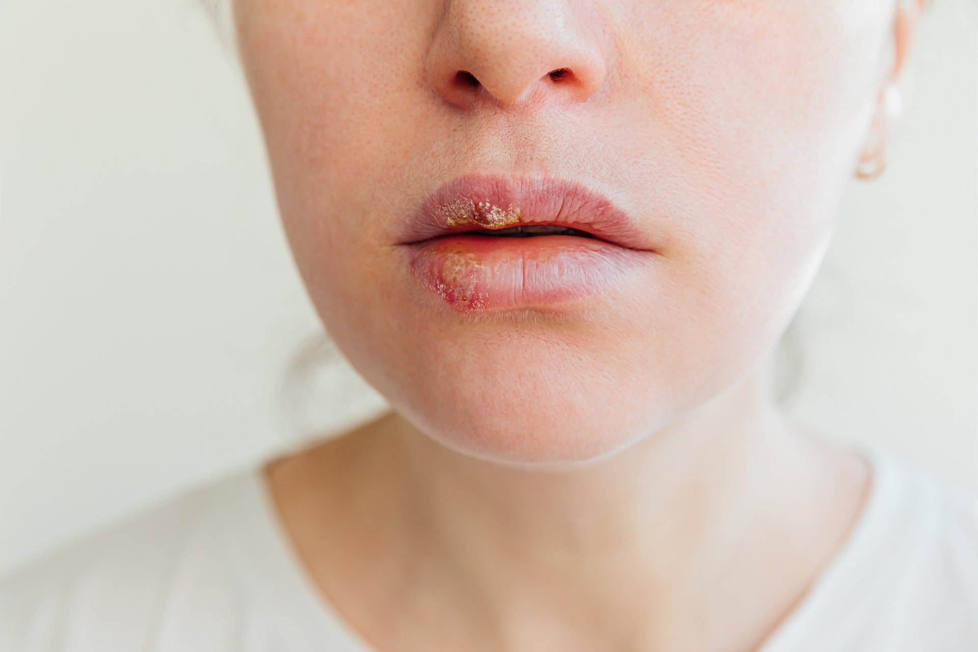 Herpes i njega usana: kako skratiti epizode i zaštititi kožu