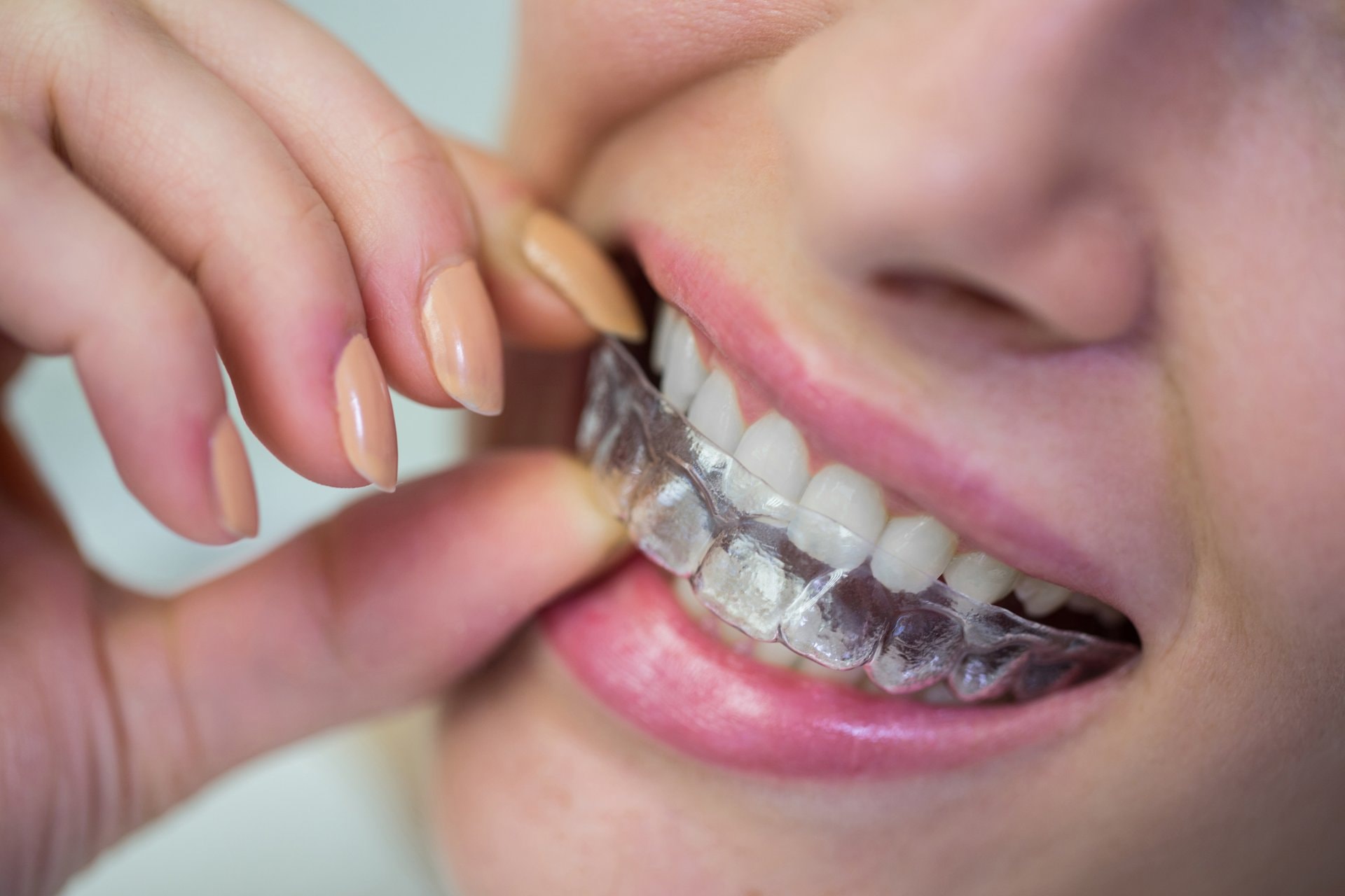 Invisalign i prozirne folije: ispravljanje zuba bez žice