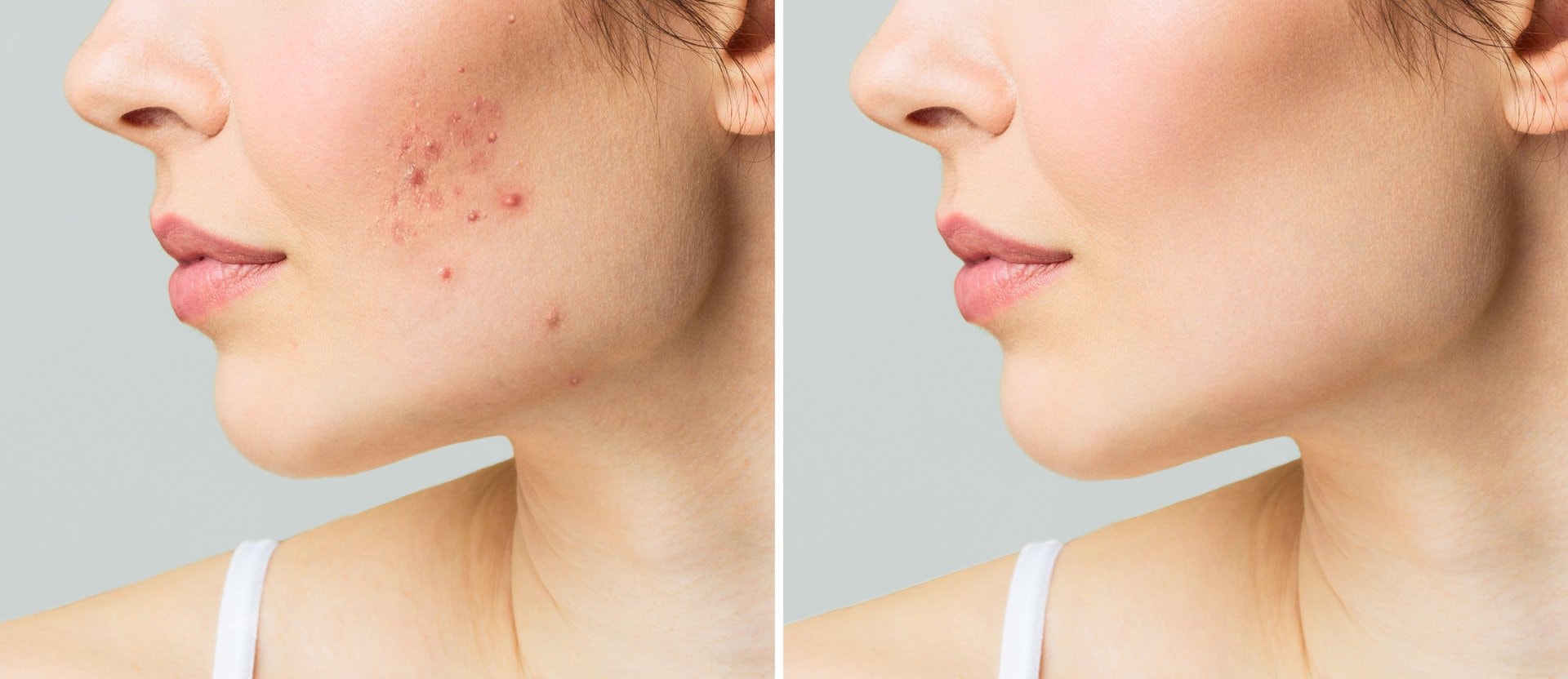 Kako odabrati makeup za akne: proizvodi koji stvarno rade