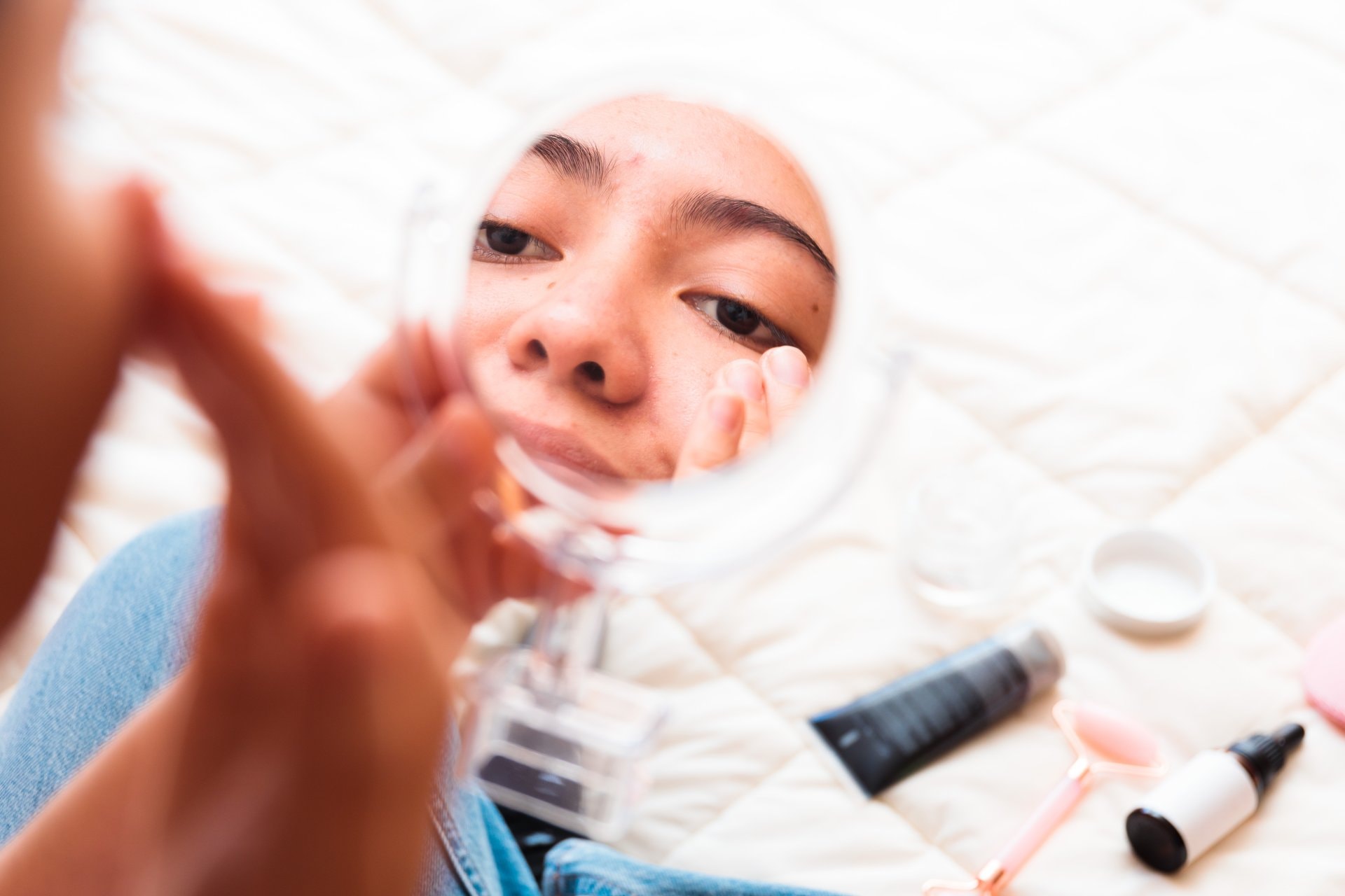 Kako spriječiti ožiljke od akni: savjeti dermatologa