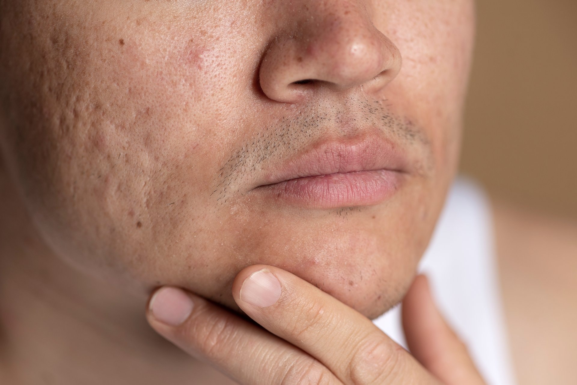Kako spriječiti ožiljke od akni: savjeti dermatologa