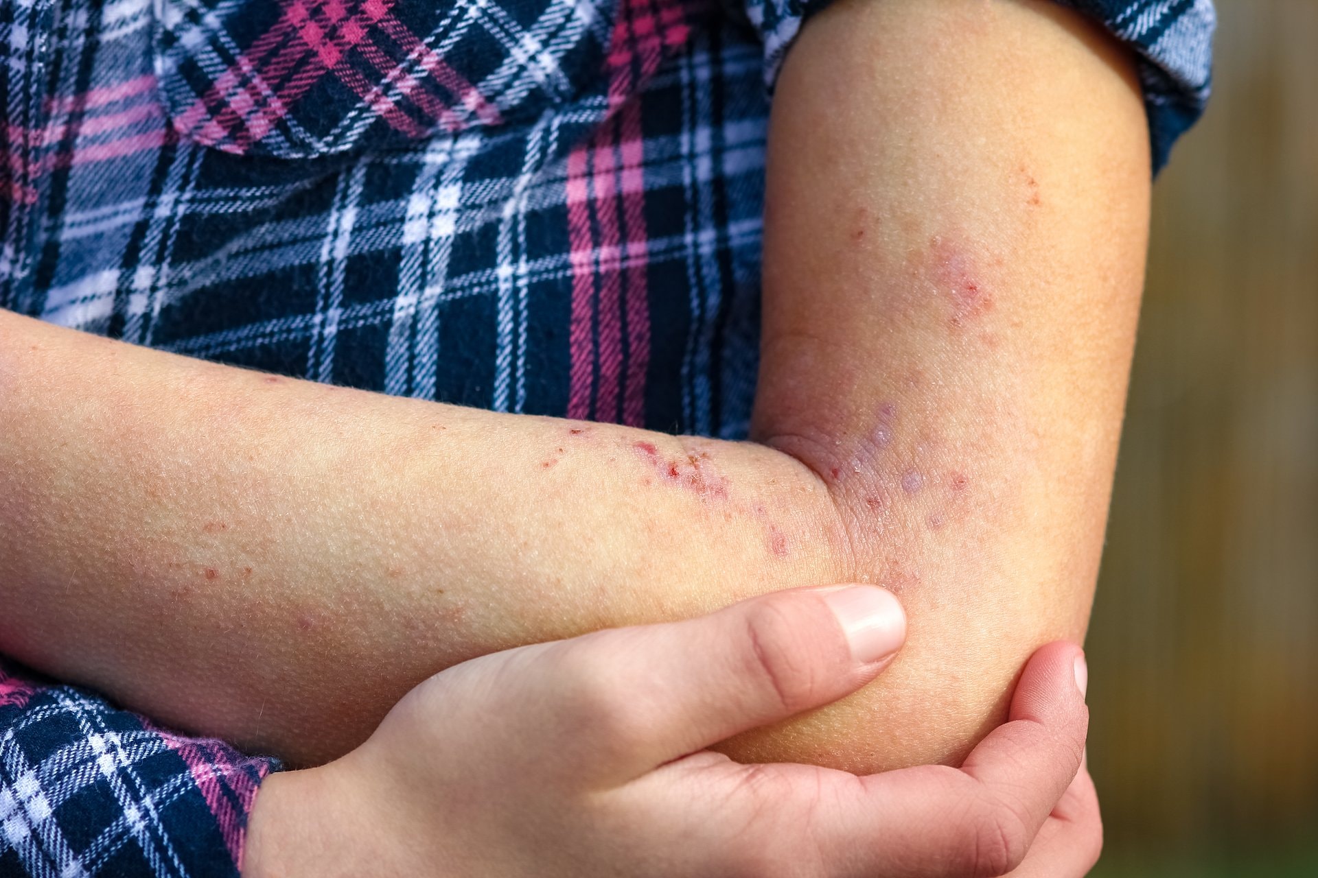 Koprivnjača od kozmetike: kako prepoznati kontaktnu alergiju