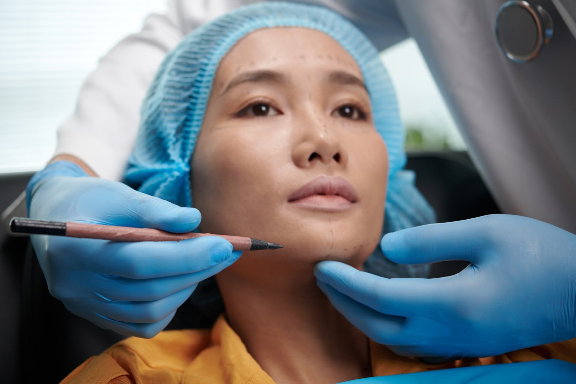 Definisana vilica: Fileri vs. Implantati za bradu