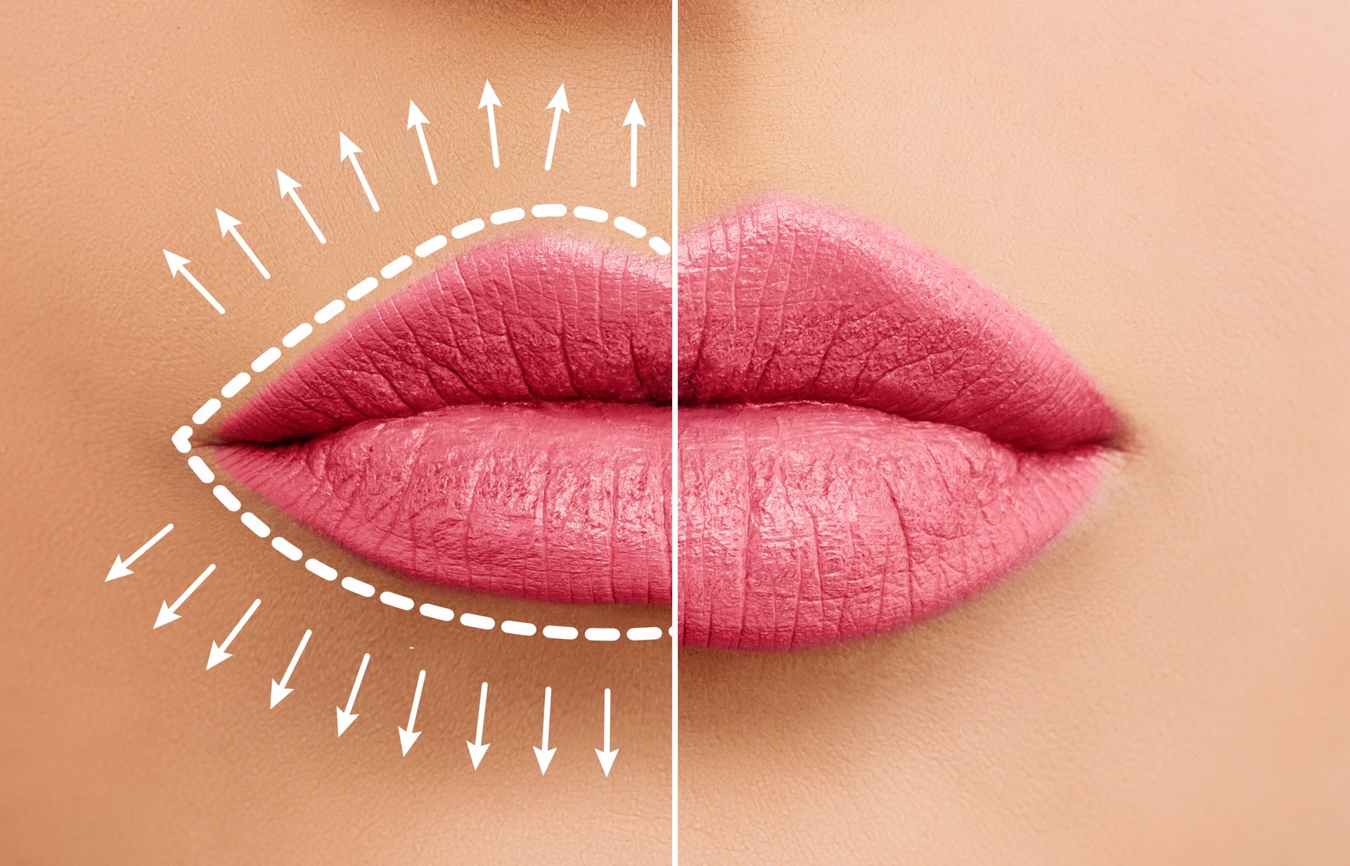Lip flip ili lip filer: šta je pravo rješenje za vaše usne