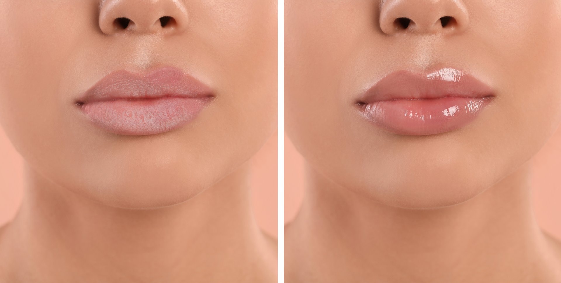 Lip flip ili lip filer: šta je pravo rješenje za vaše usne