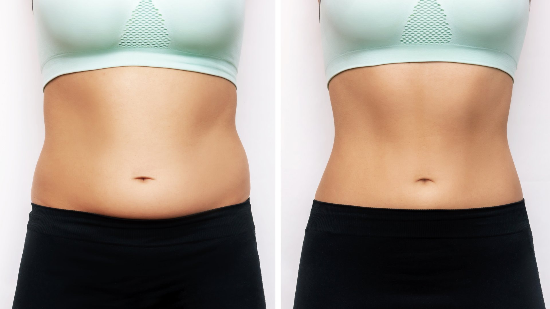 Lipoliza injekcijama vs. liposukcija: koju metodu odabrati