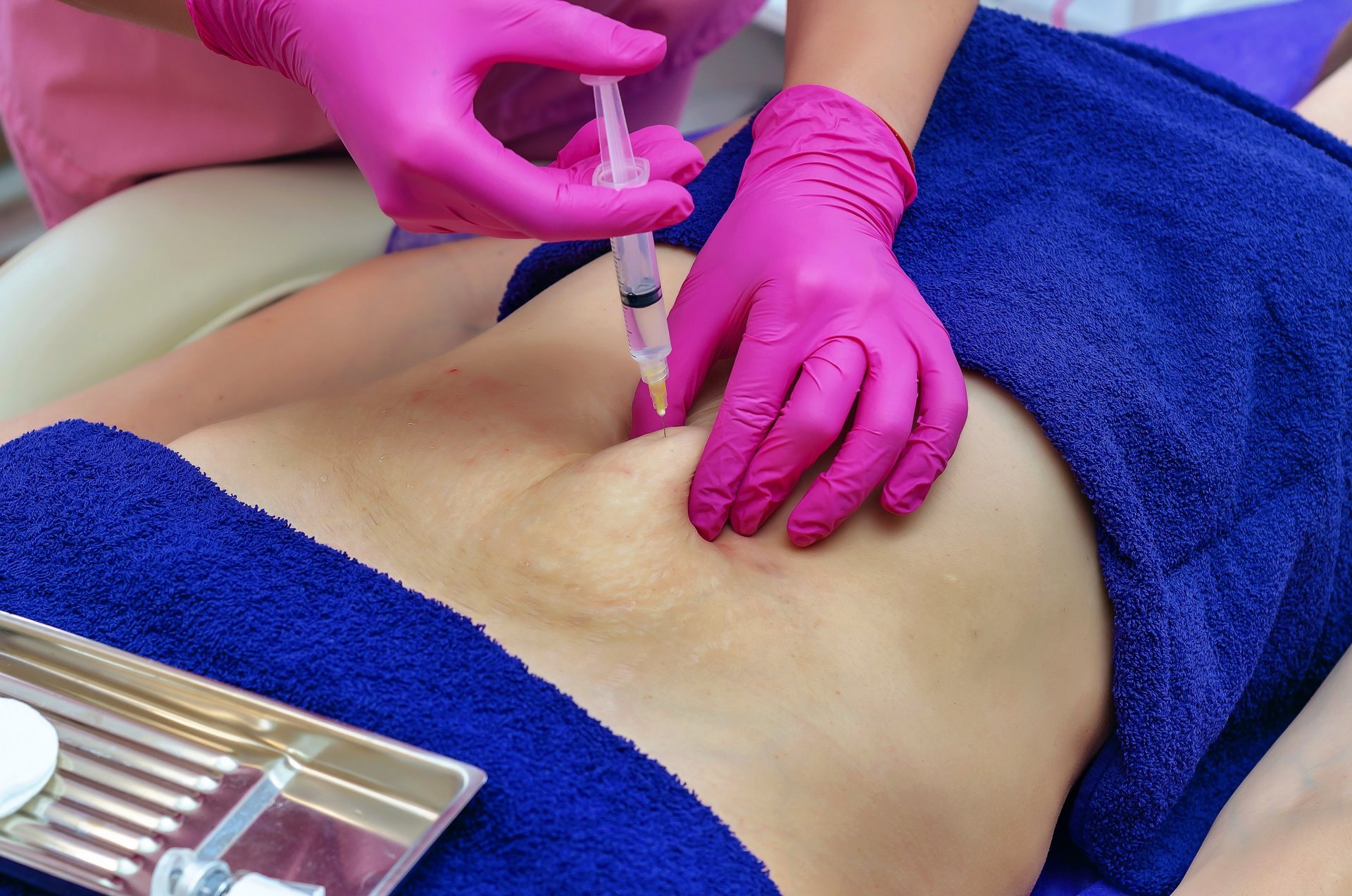 Lipoliza injekcijama vs. liposukcija: koju metodu odabrati