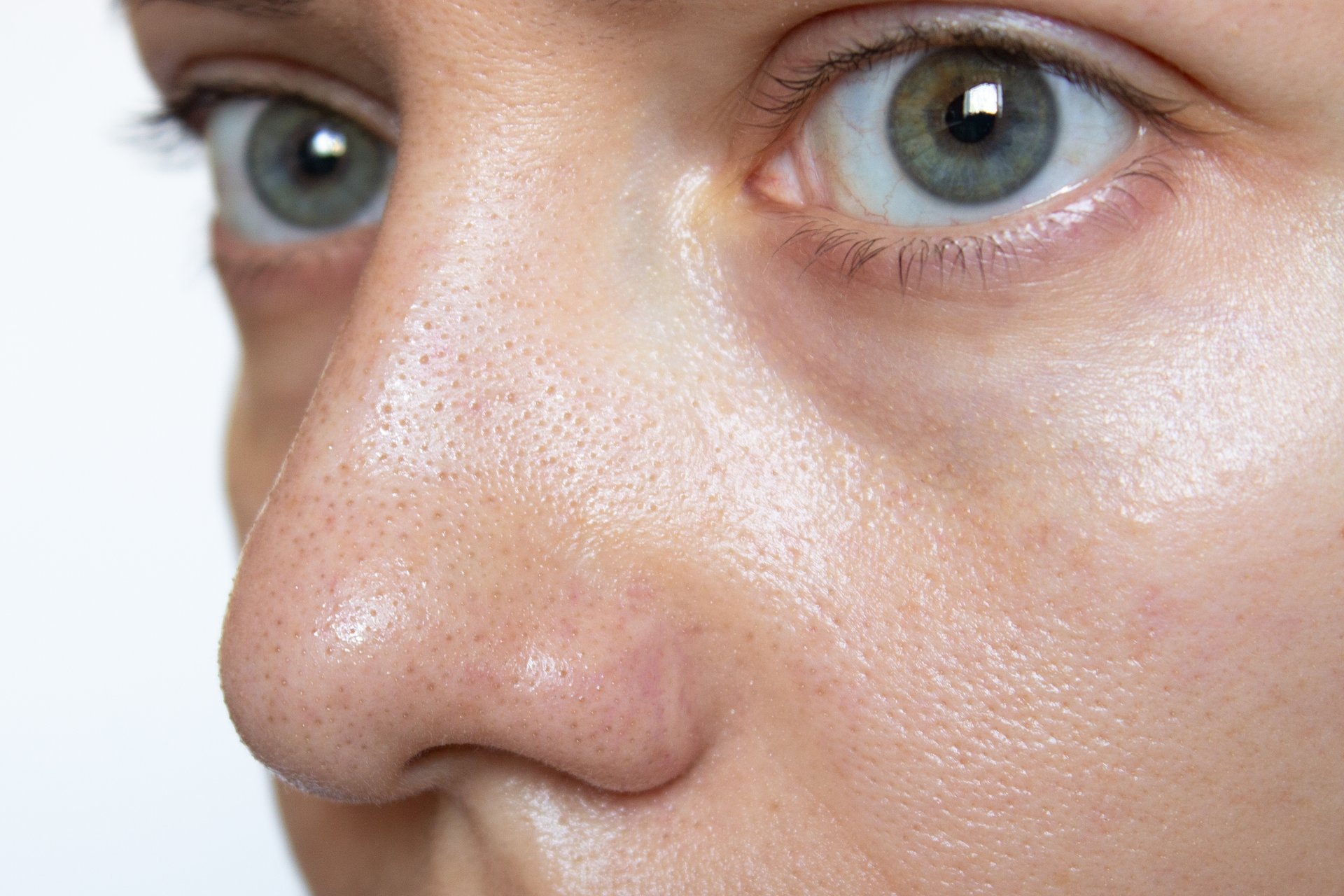 Šta je Microbotox? Rešenje za pore i kontrolu sebuma