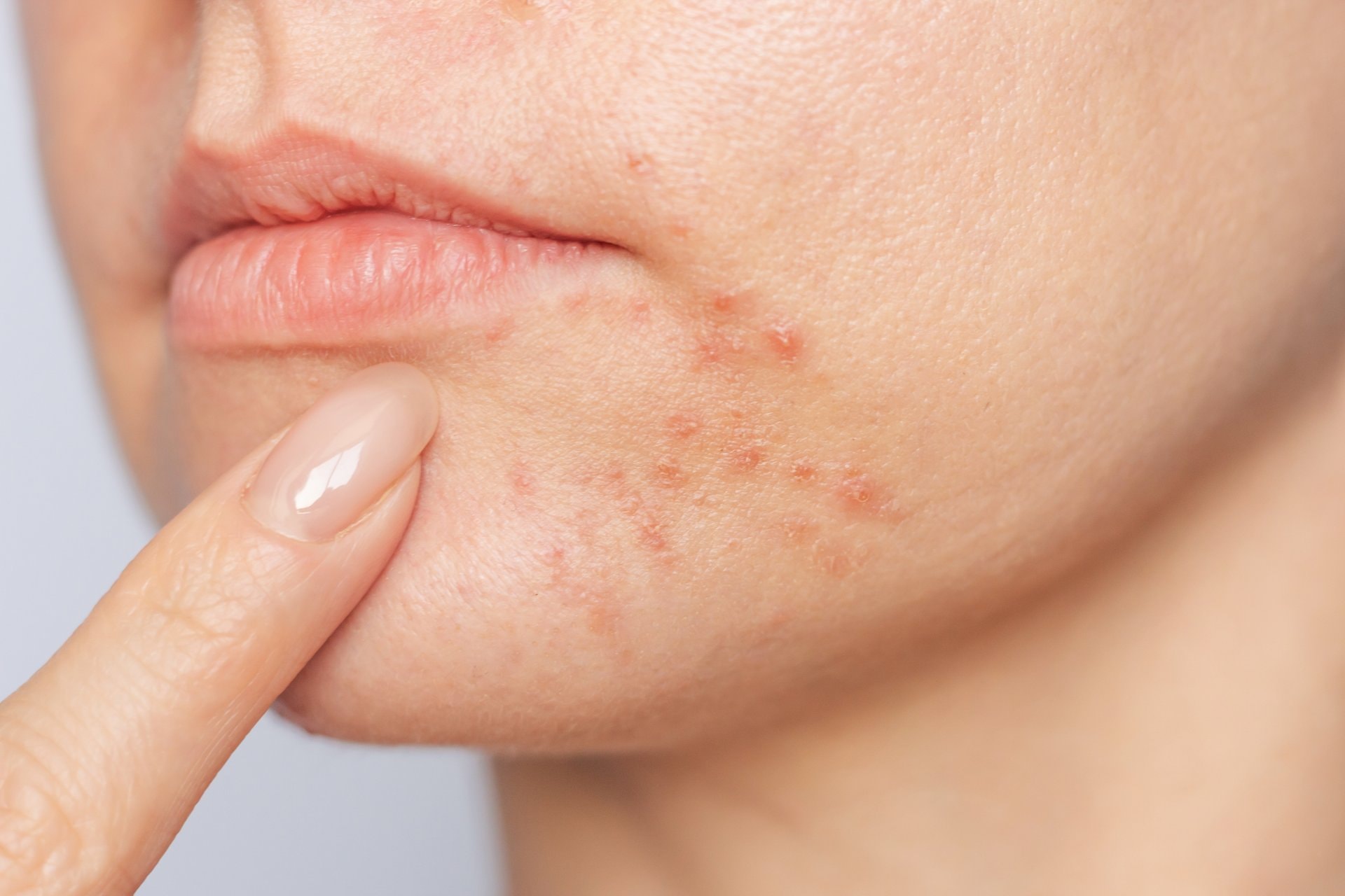 Perioral dermatitis: zašto nastaje i kako ga zaista riješiti