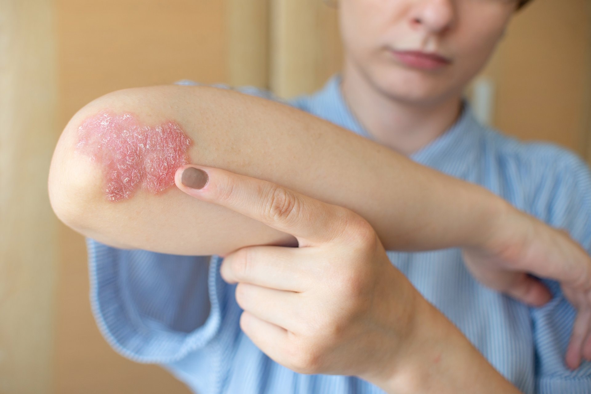 Psoriaza i njega kože: šta dermatolog savjetuje za svaki dan