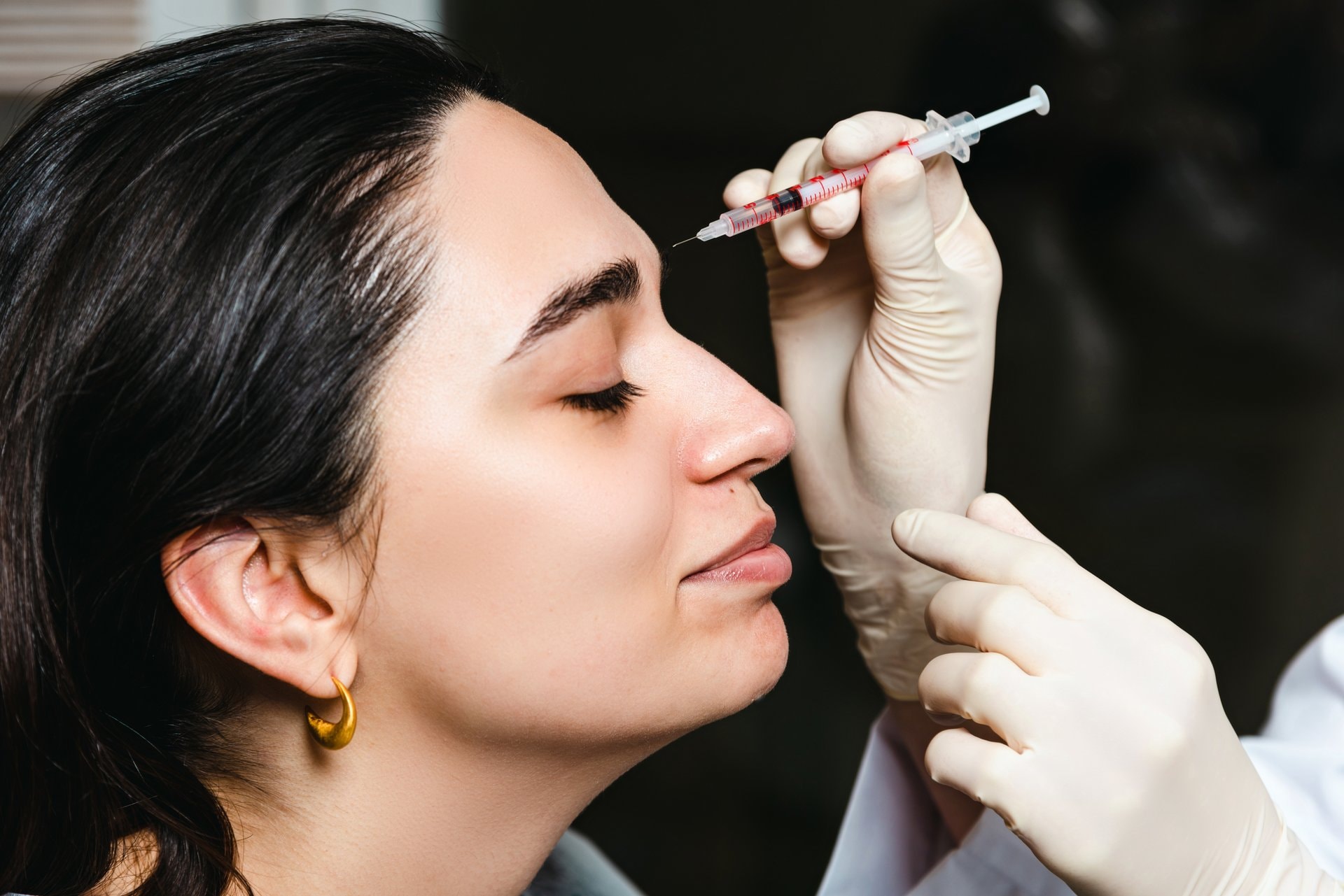 Rinoplastika bez operacije: fileri za nos u praksi