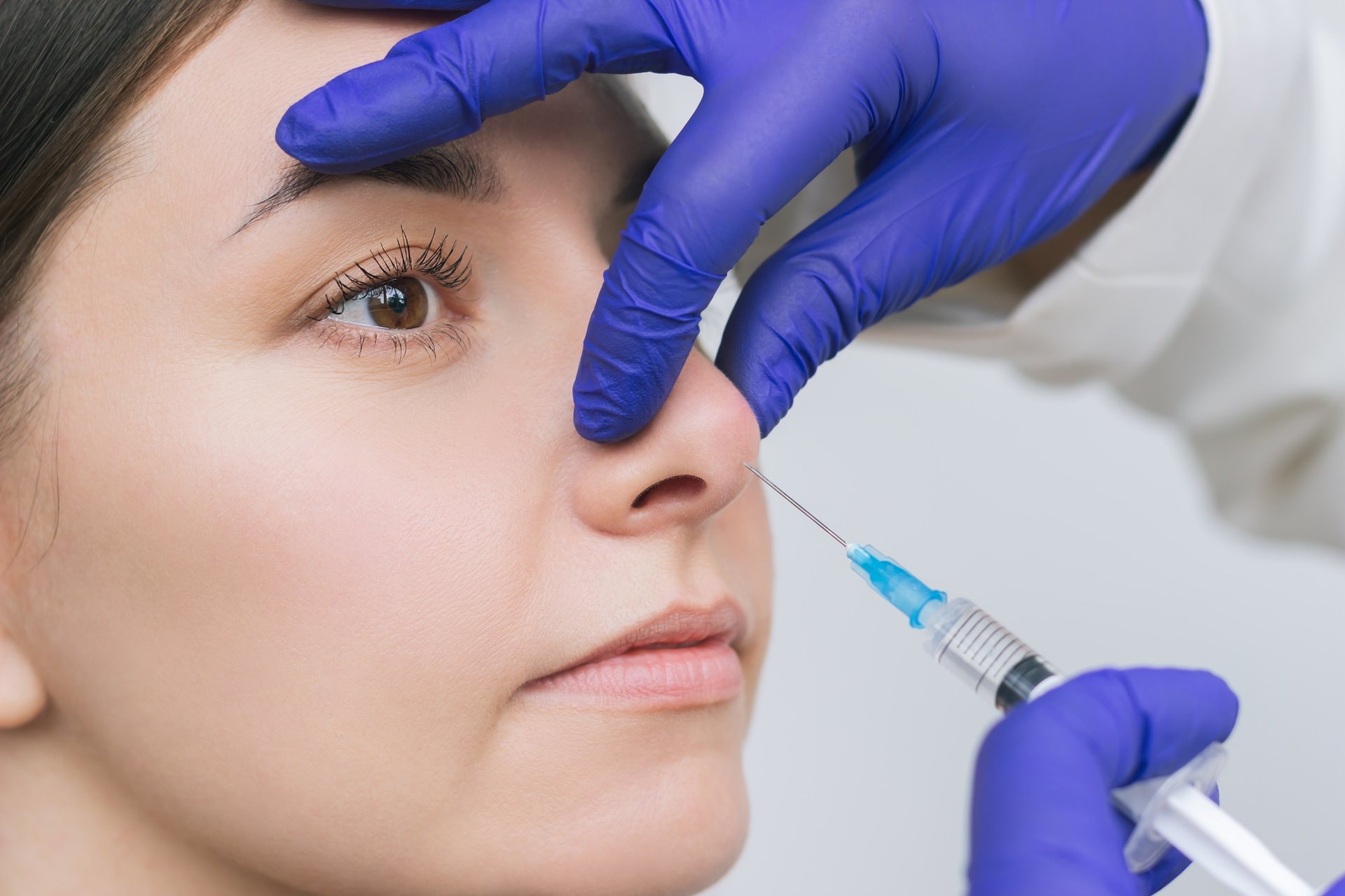 Rinoplastika bez operacije: fileri za nos u praksi