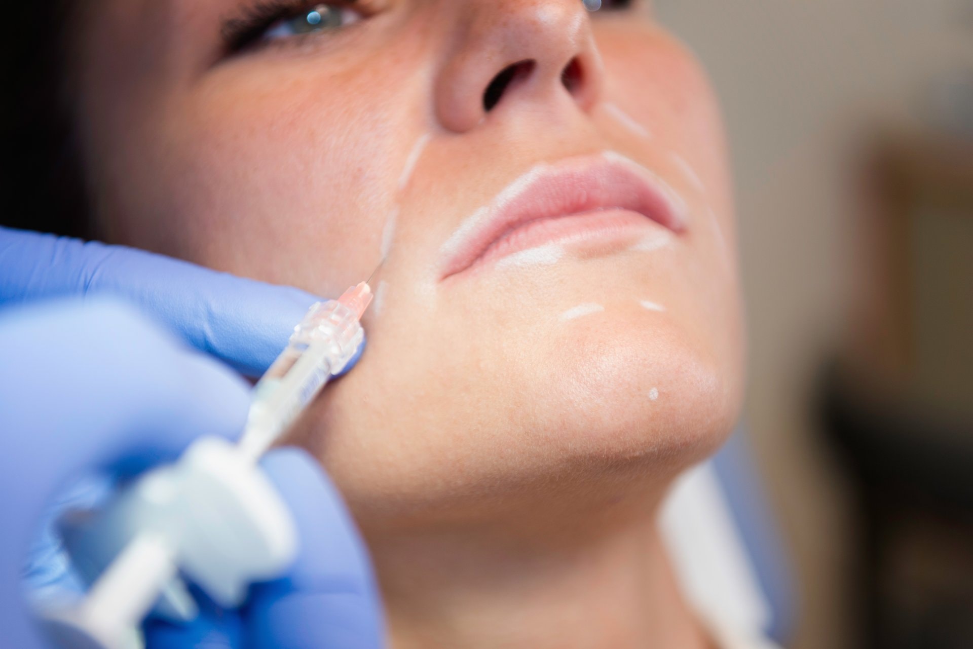Sculptra: pregled sistema za regeneraciju kolagena