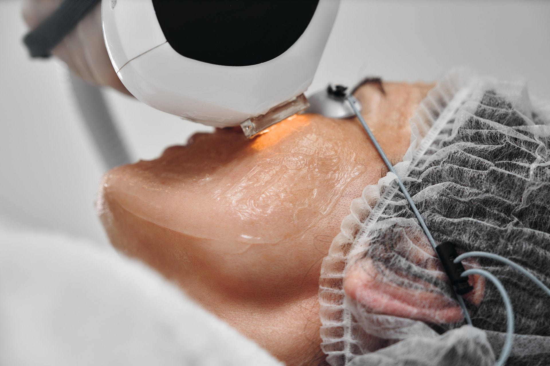 Vodič za uklanjanje pjega: IPL protiv Piko lasera