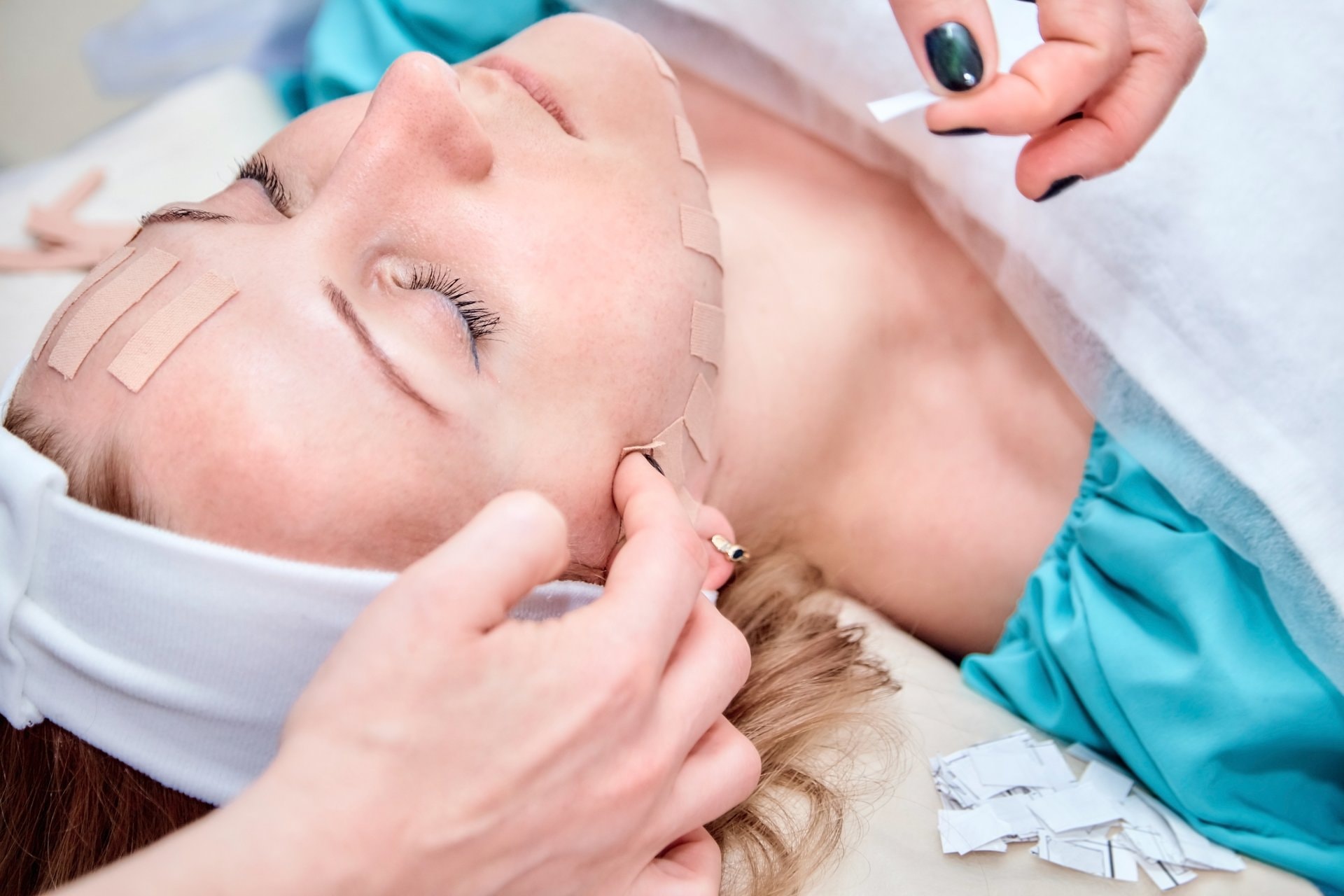 Threadlifting: neinvazivni lifting lica koncem