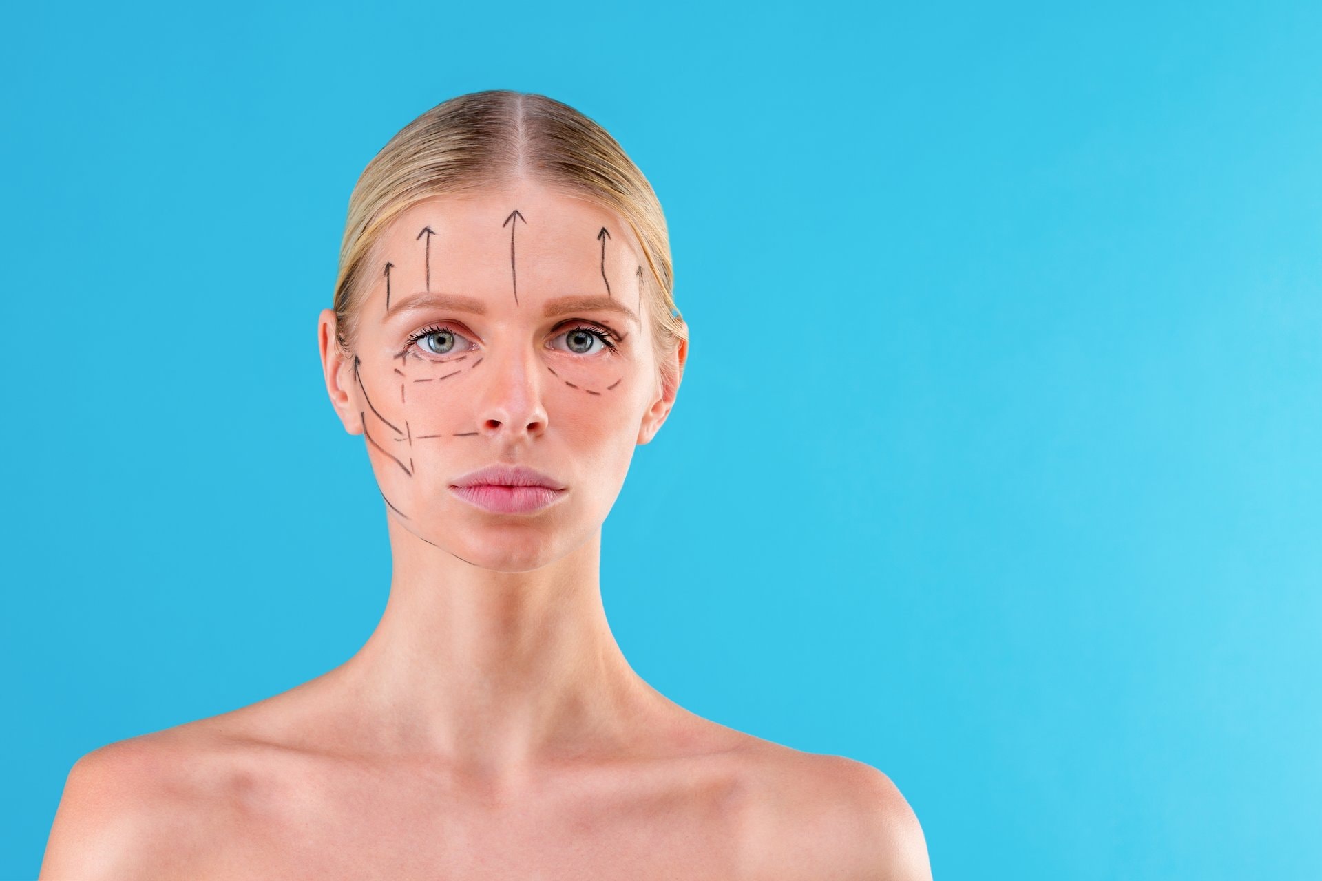 Threadlifting: neinvazivni lifting lica koncem