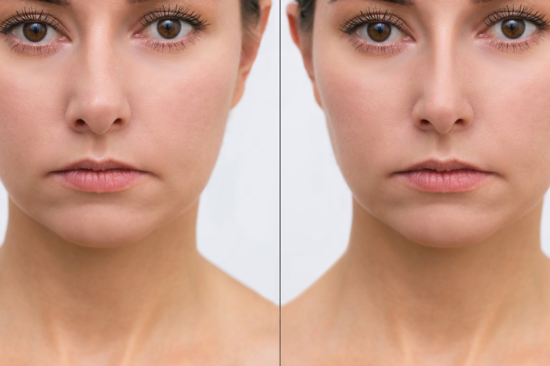 Ultherapy: ultrazvučni lifting bez operacije