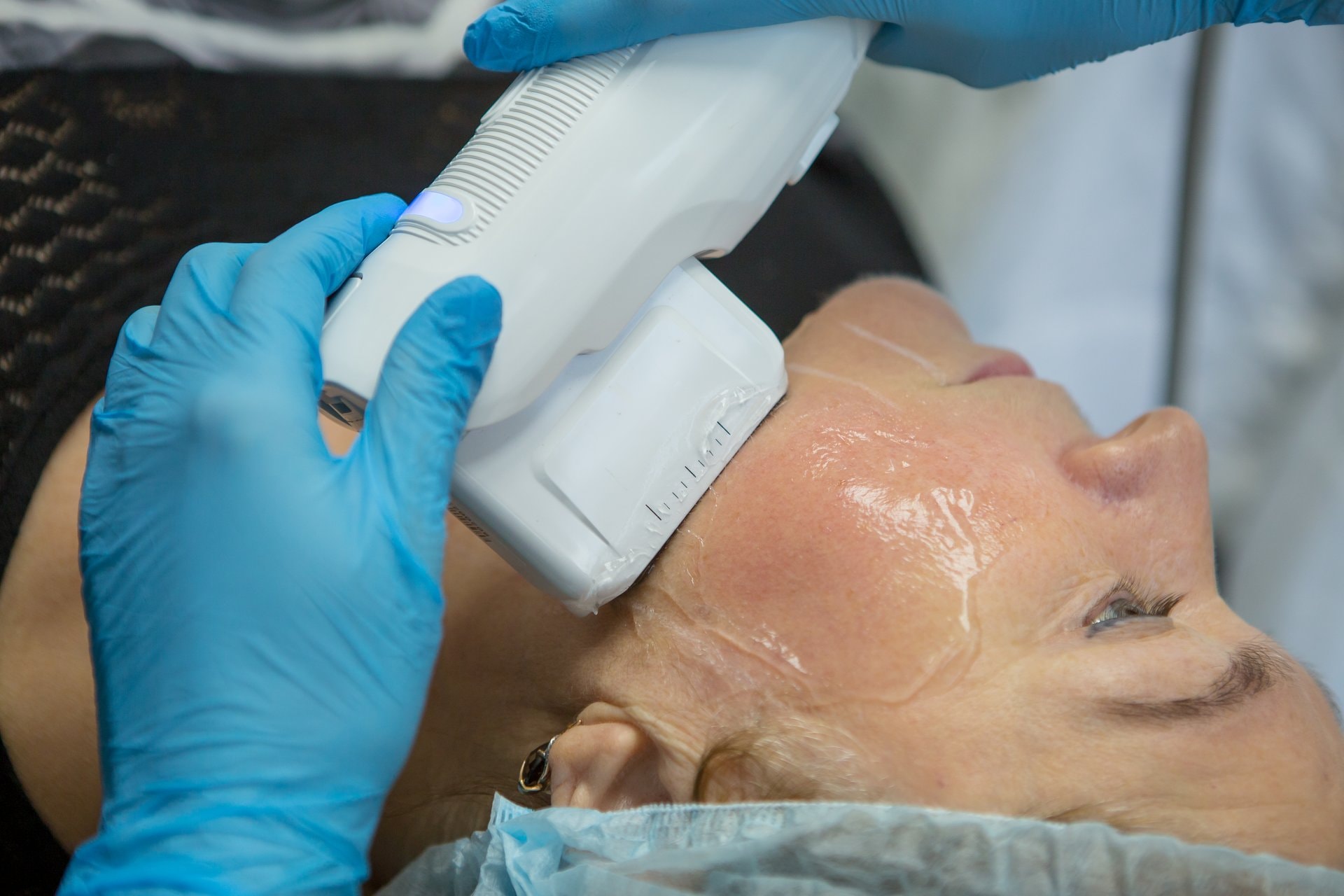 Ultherapy: ultrazvučni lifting bez operacije