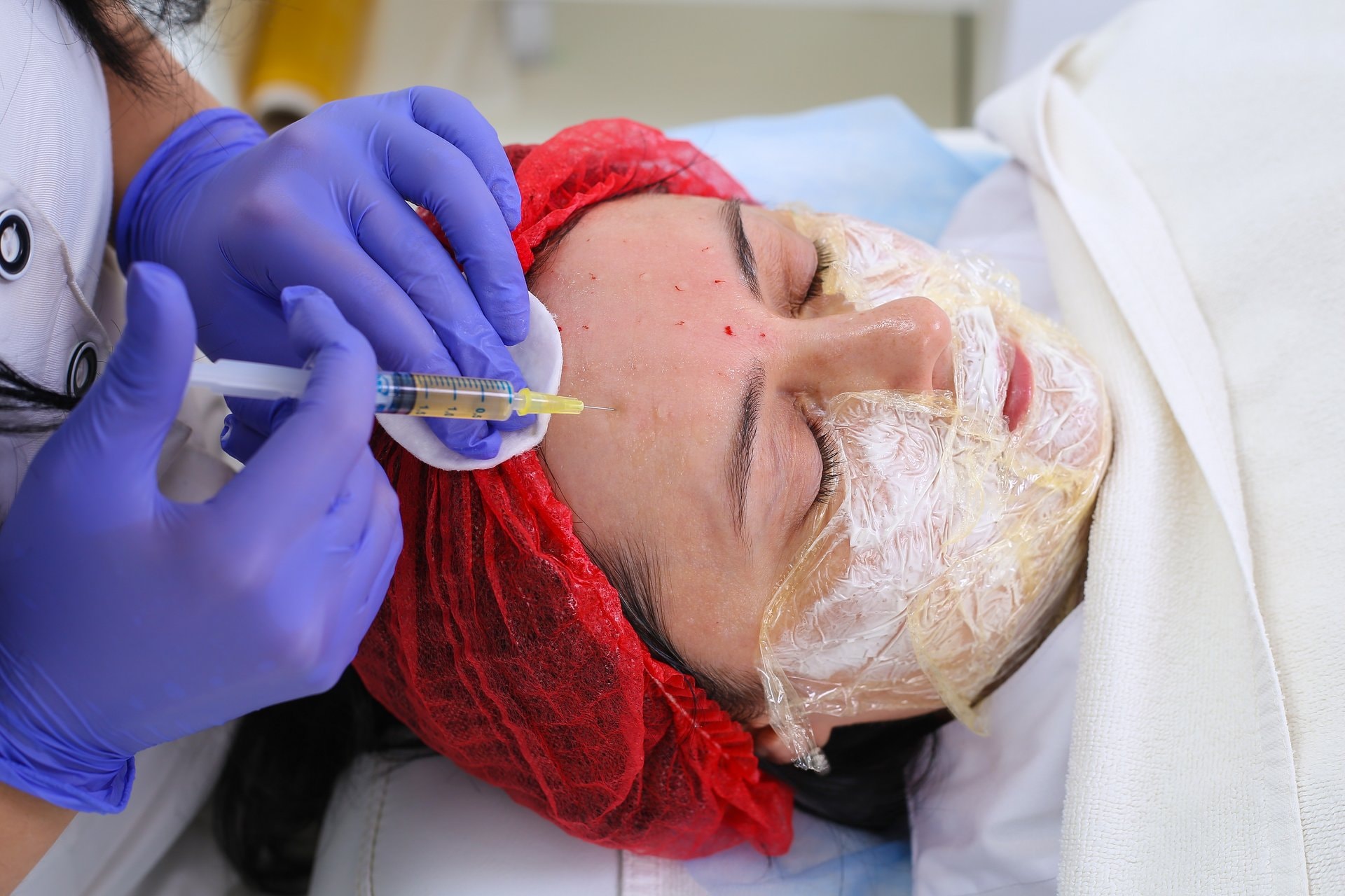 Vampire facial: PRP i mikroneedling za prirodno pomlađivanje