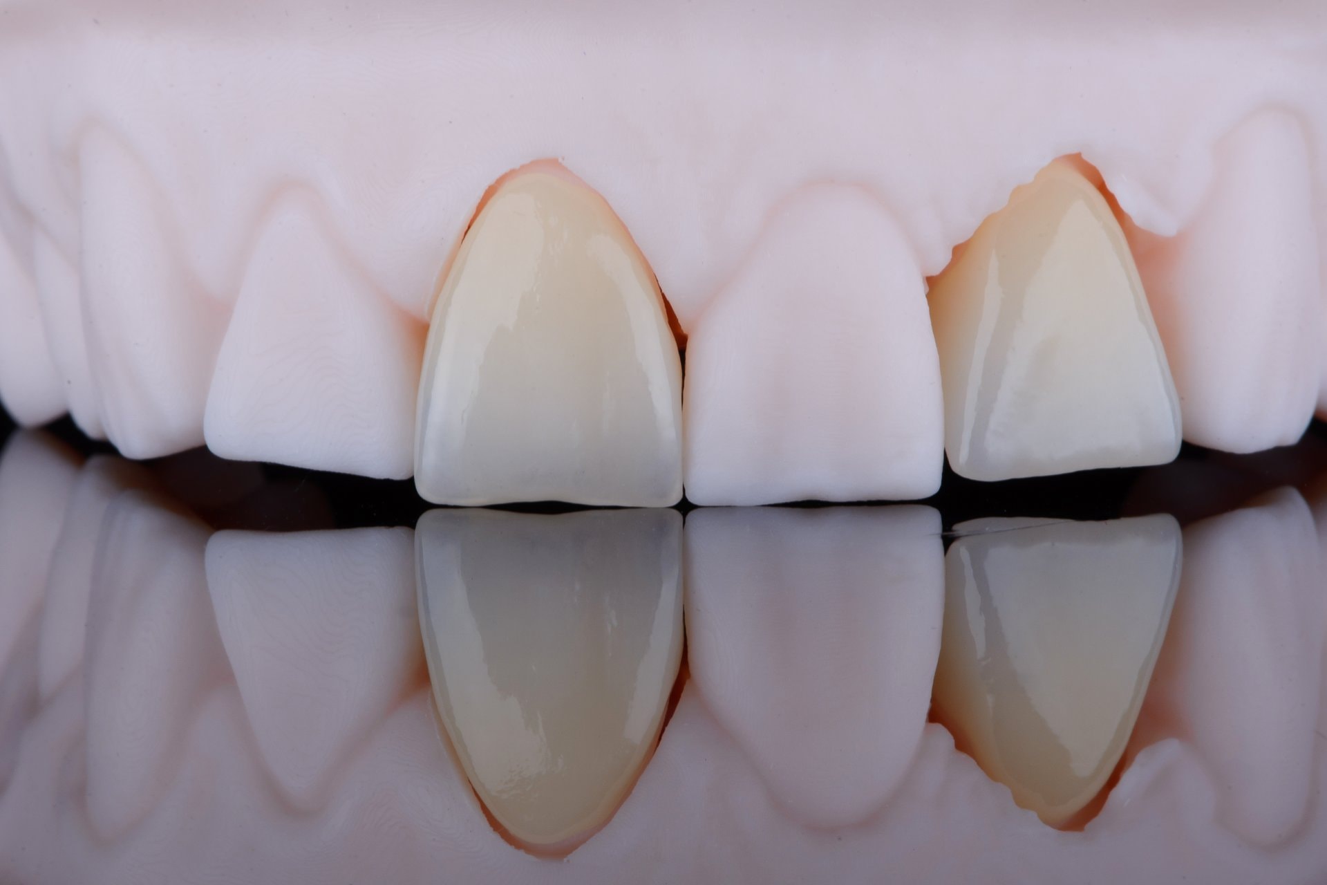 Veneers ili kompozitne ljuskice: uporedni vodič