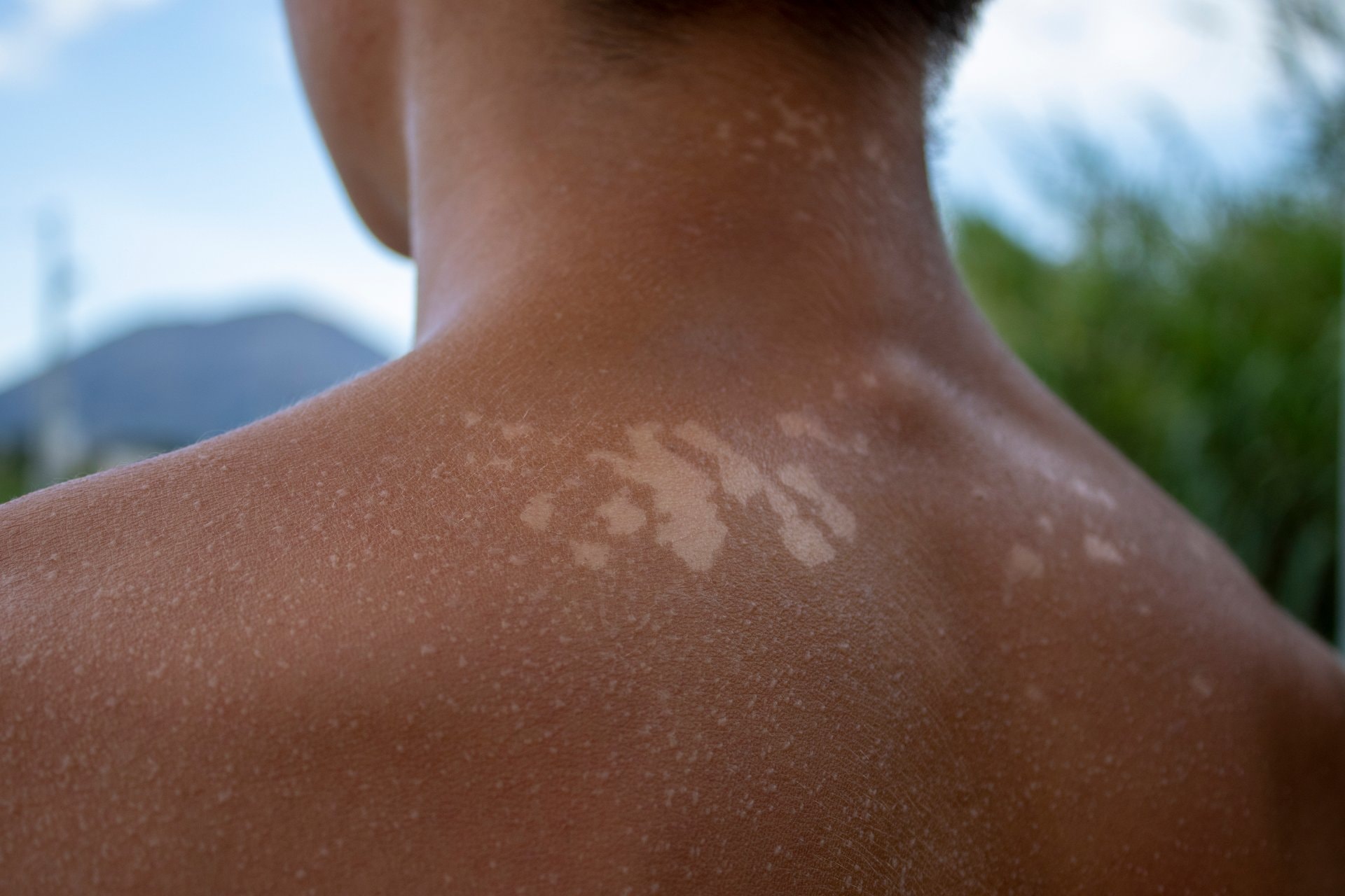 Vitiligo: Sve o njezi kože i zaštiti od sunca