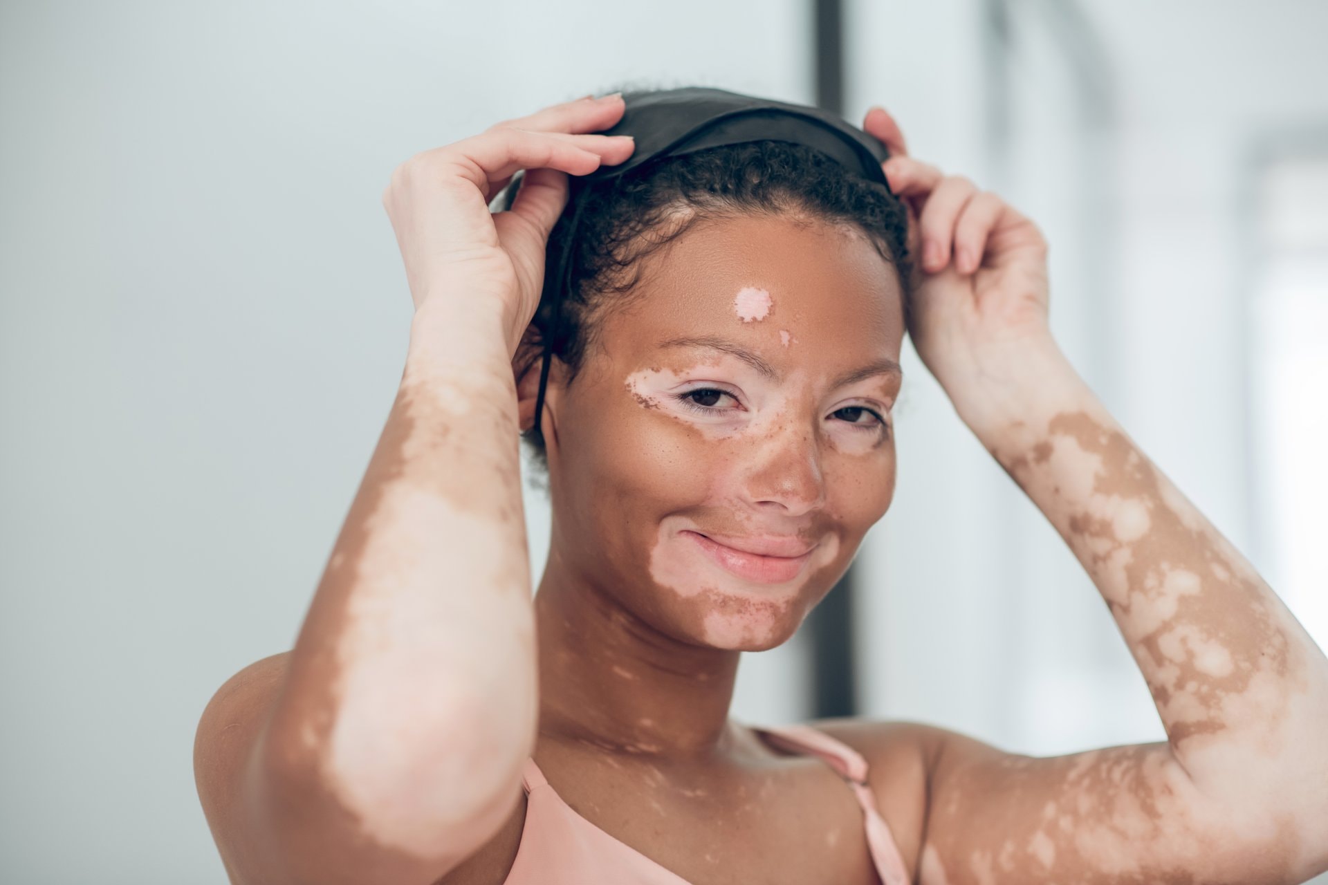 Vitiligo: Sve o njezi kože i zaštiti od sunca
